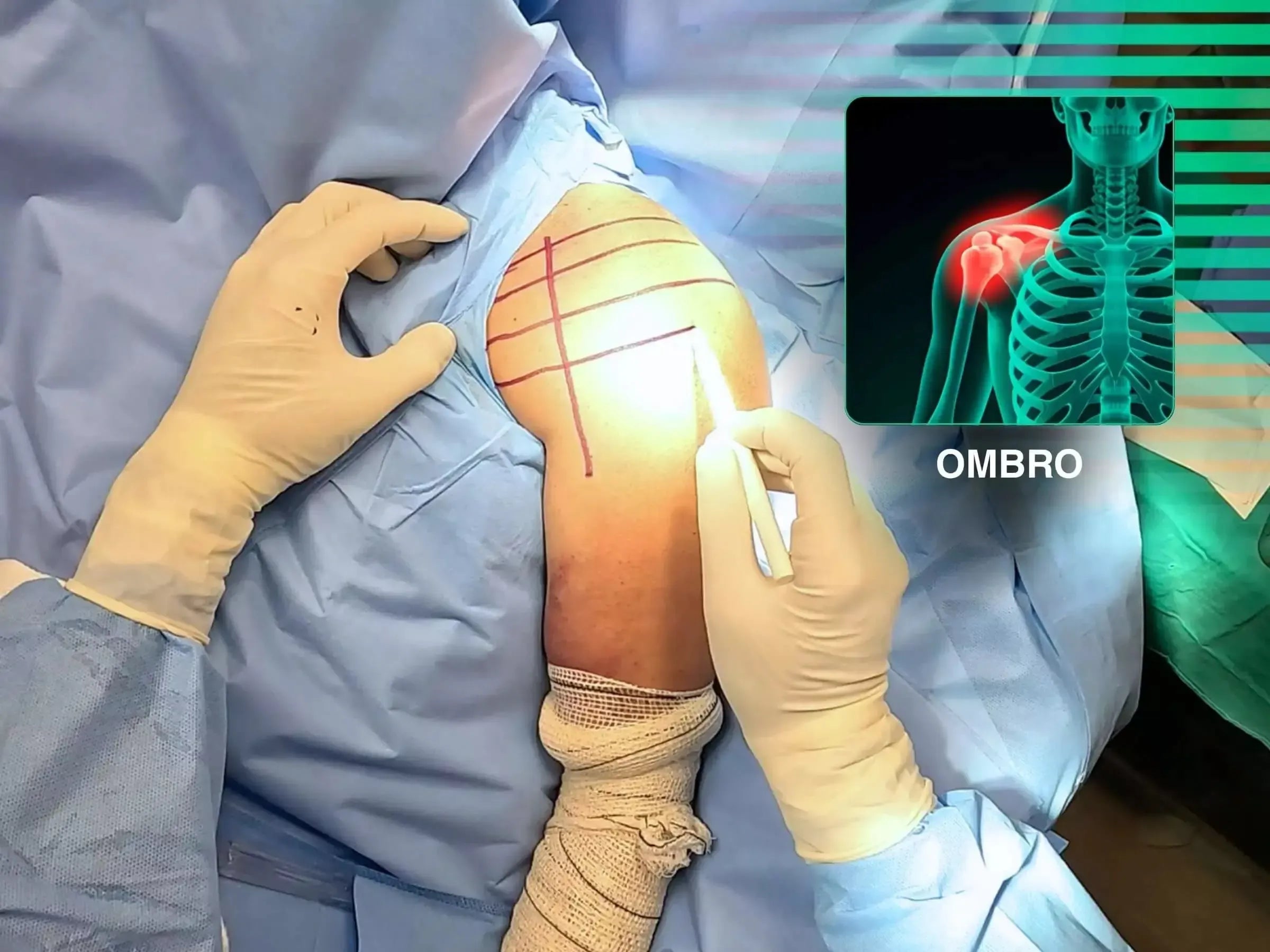 Fratura do Úmero Proximal em Quatro Partes (Acesso Deltopeitoral)