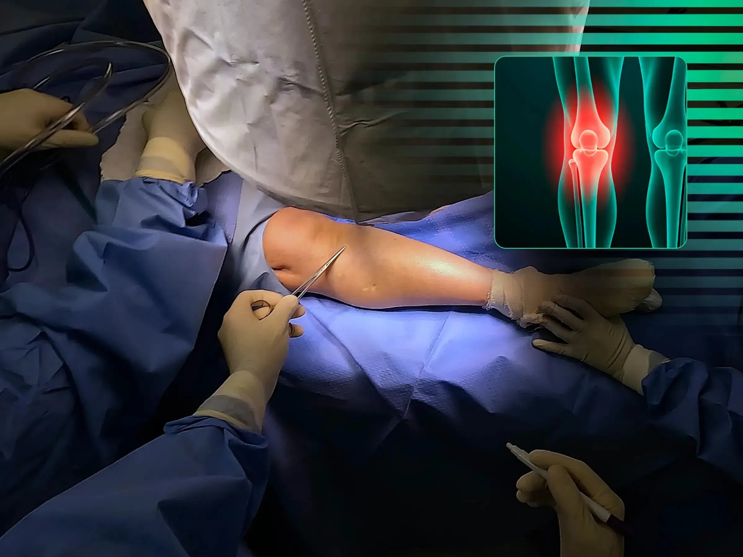 Diaphyseal Tibia Fracture with Deformity