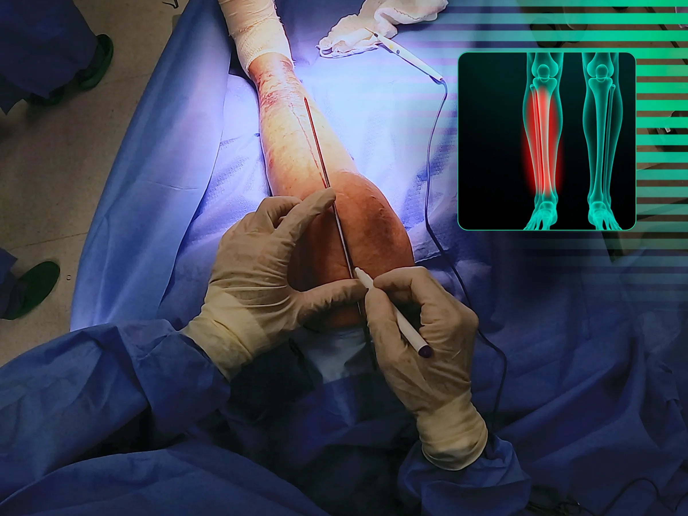 Fratura Diafisária Distal de Tíbia via Haste Intramedular com Acesso Suprapatelar