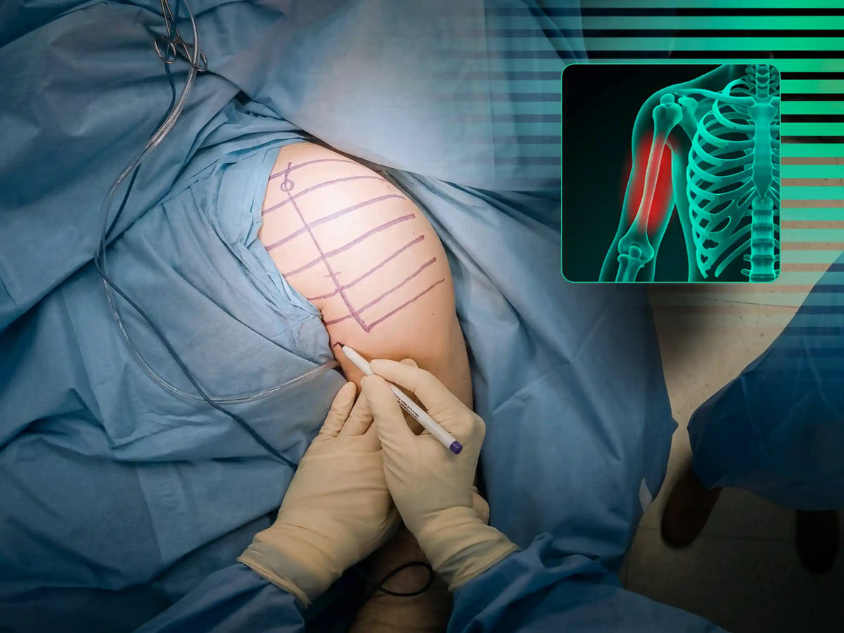 ÚMERO PROXIMAL [CASO 07] - Head-Split Em Paciente Jovem Placa E Parafusos