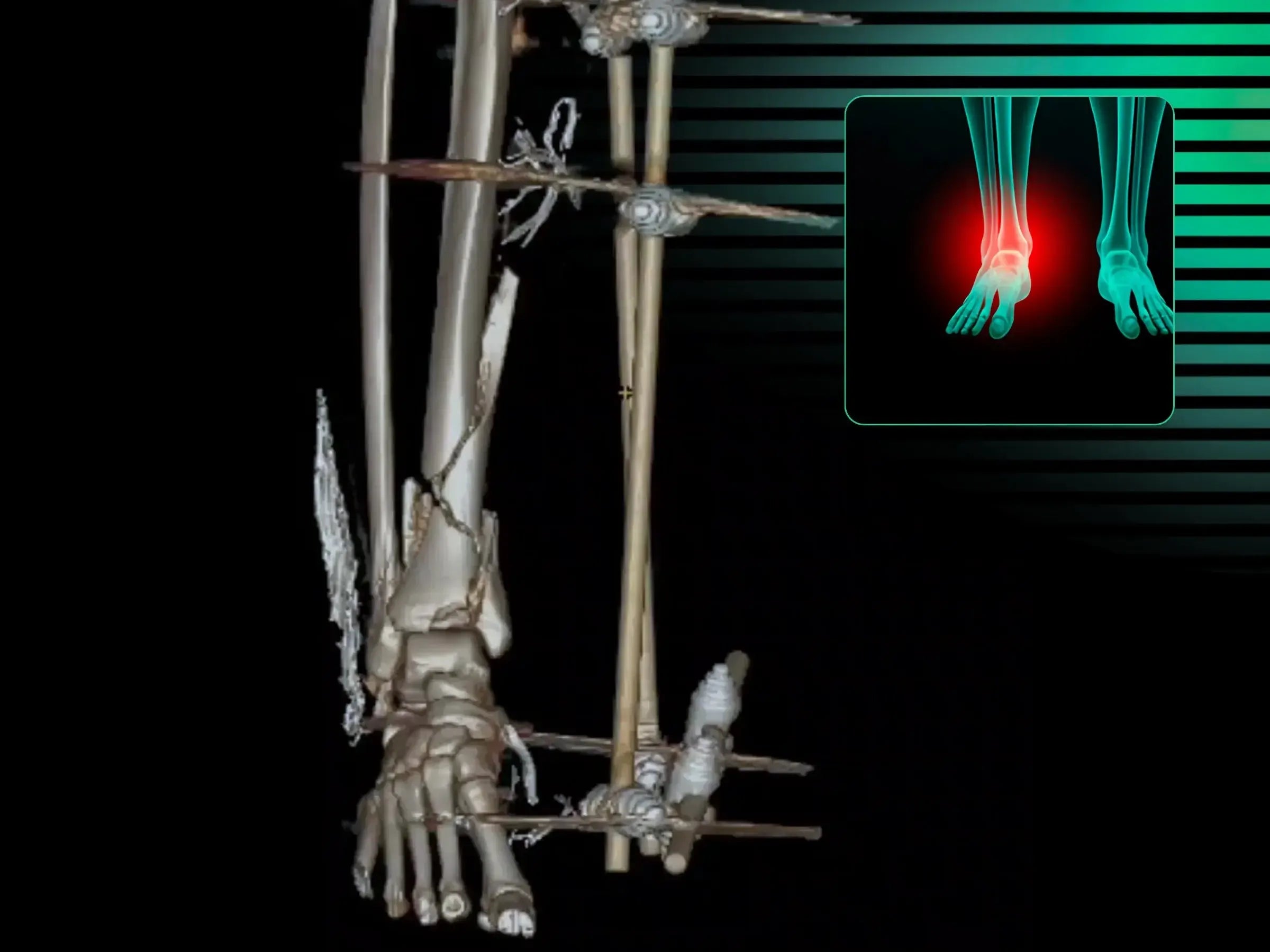 Multifragmentary Tibial Pilon Fracture (High-Energy Trauma)