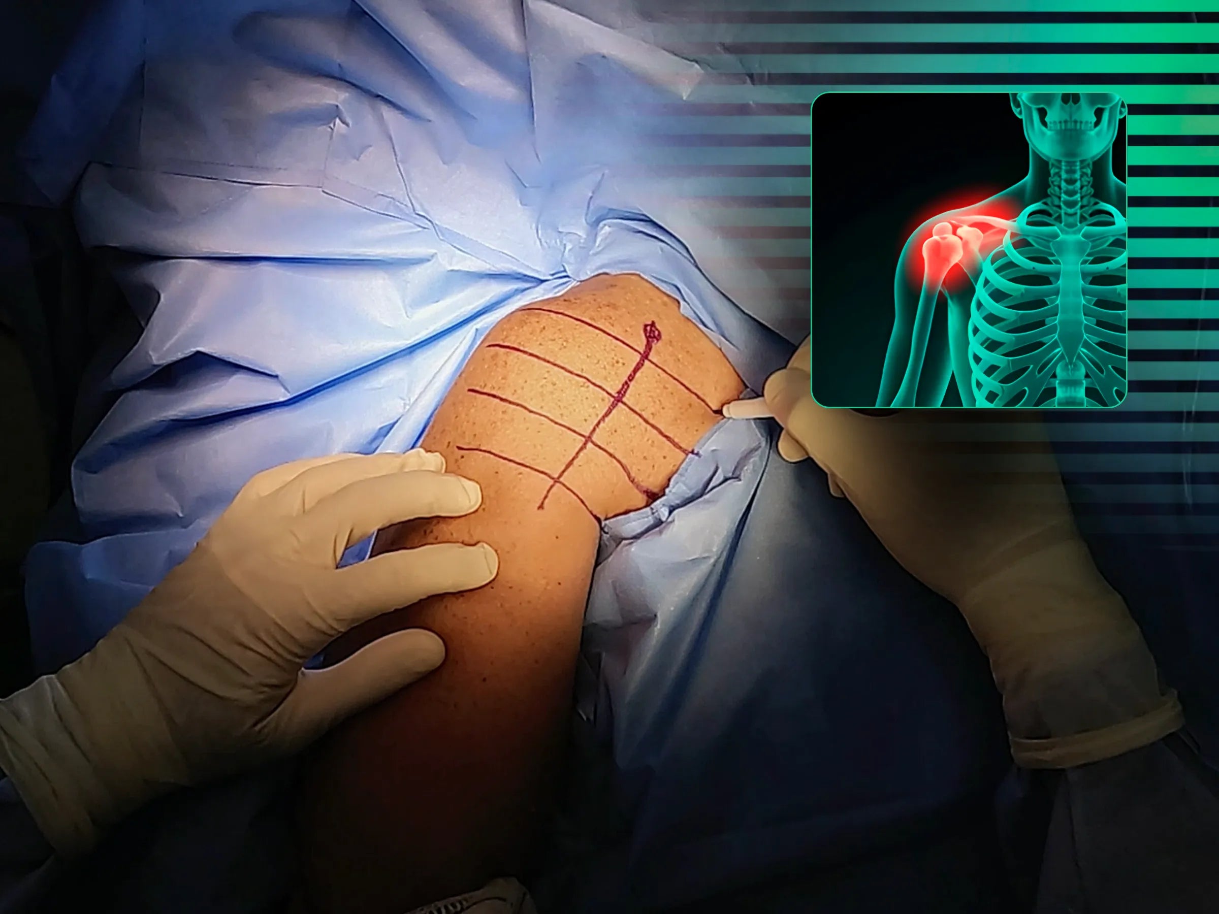 Fratura da Grande Tuberosidade do Úmero com Acesso Deltopeitoral