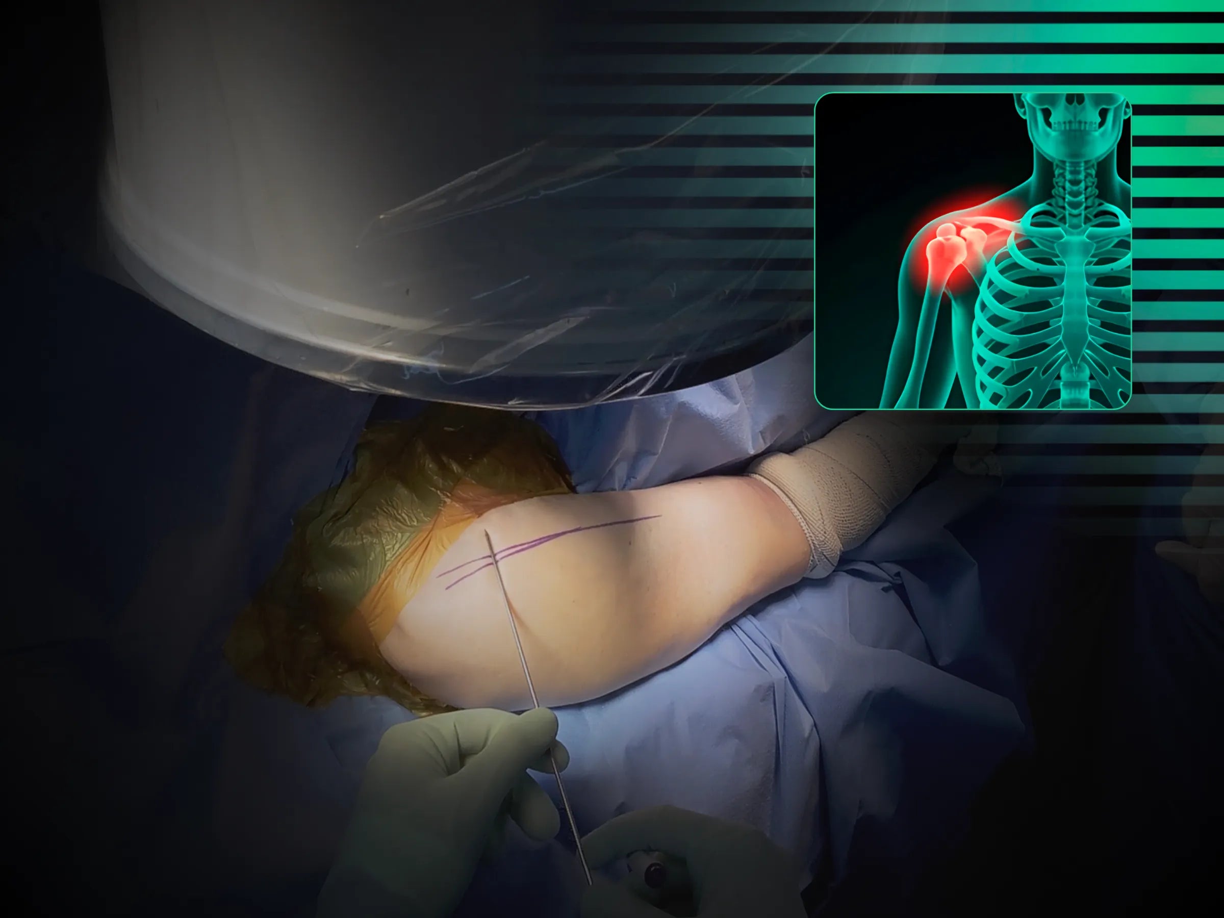 Haste Intramedular para Úmero Proximal (03)