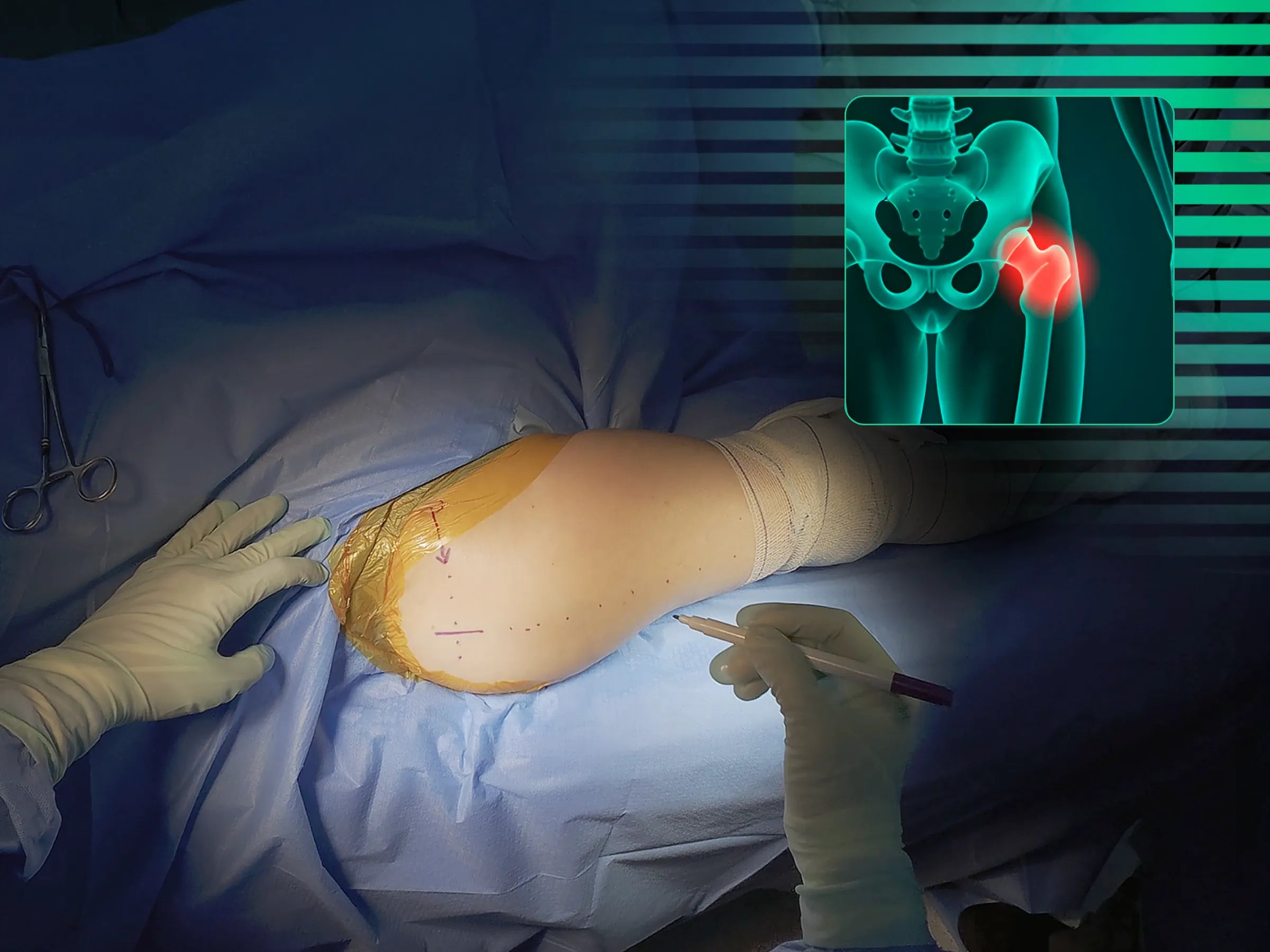 Haste Intramedular Para o Fêmur Proximal 03 - Manobra Da Gangorra