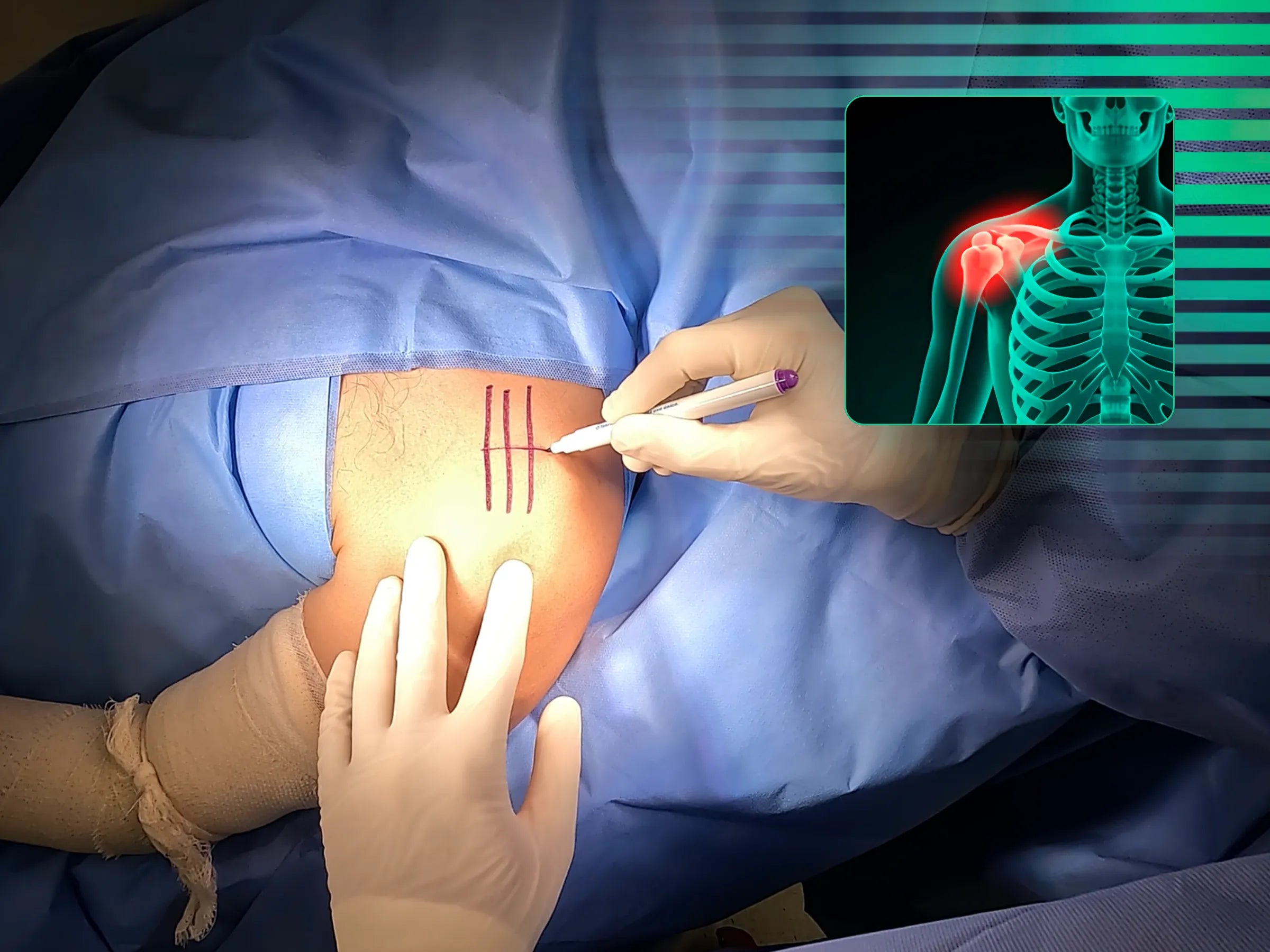 Luxação Acromioclavicular com Dispositivo TightRope