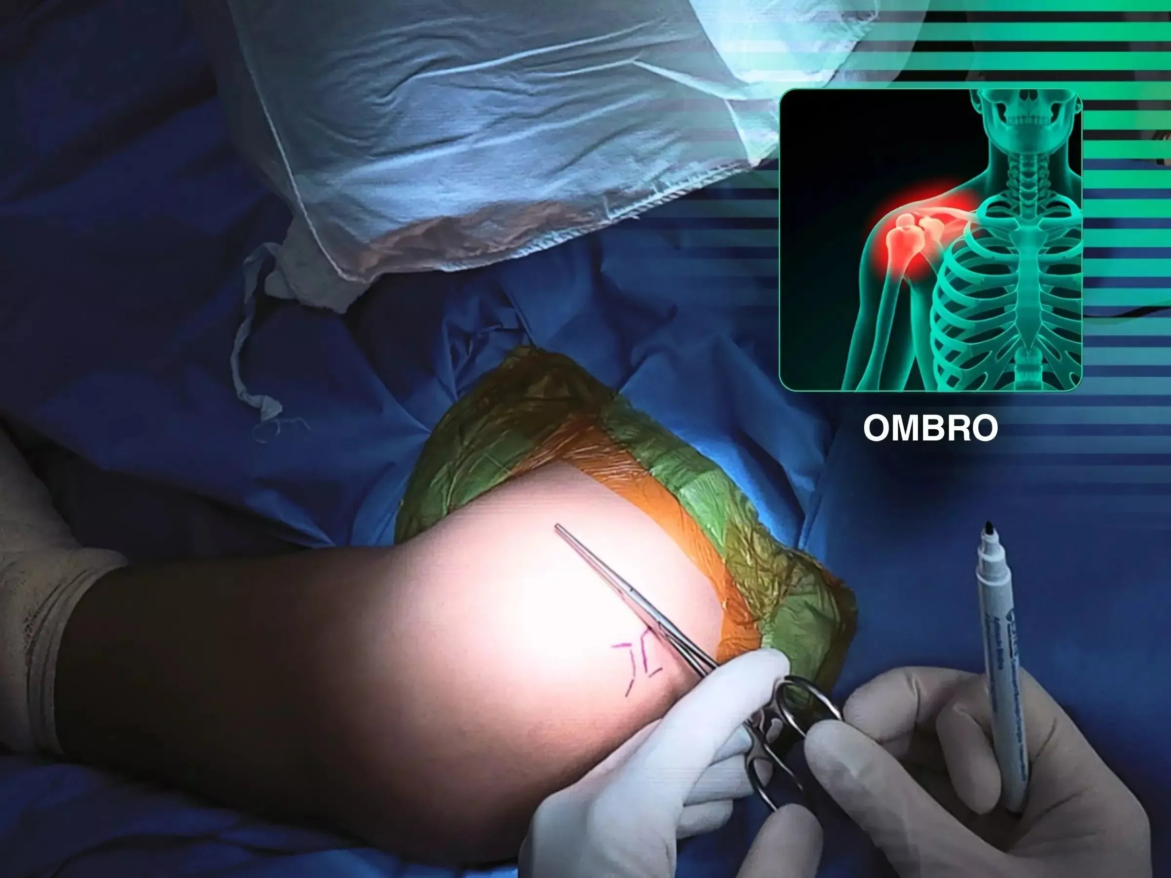 Luxação Acromioclavicular com Dispositivo TightRope
