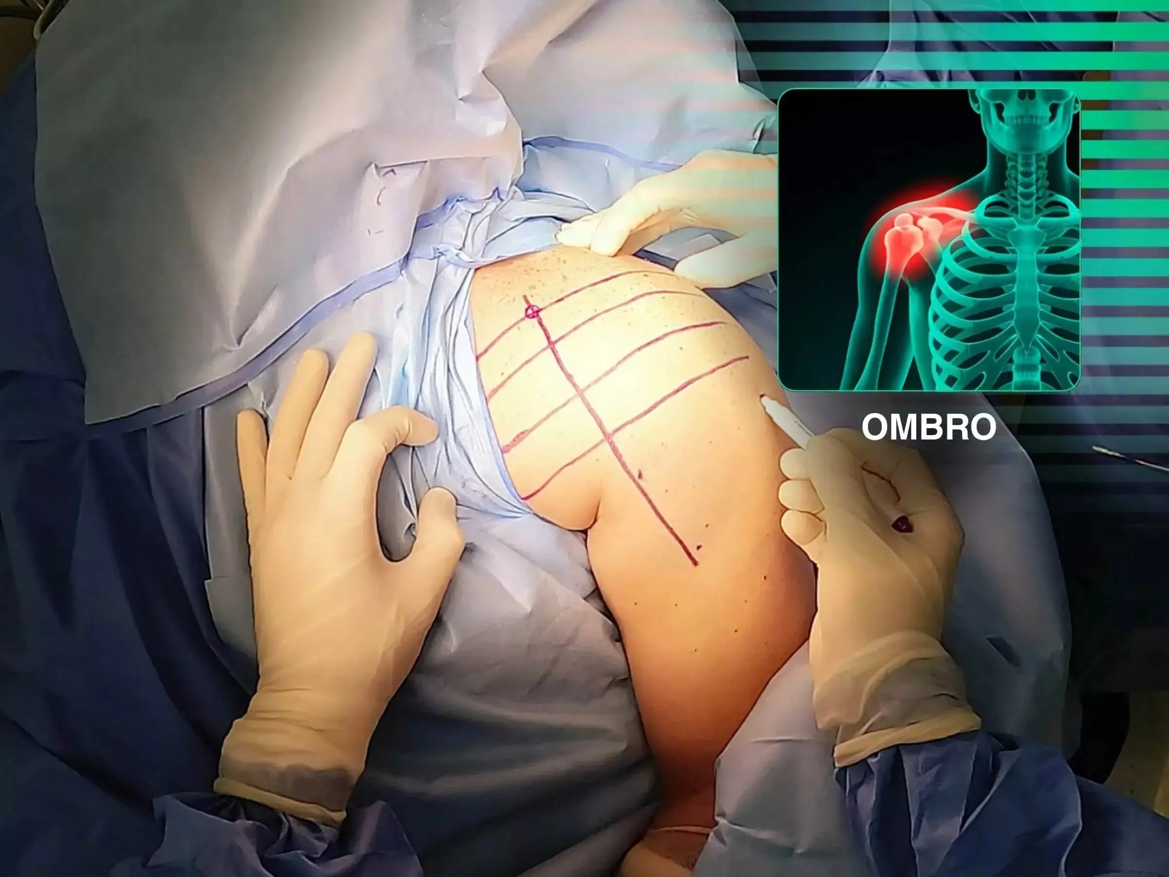 Luxação Posterior do Ombro com Impactação da Cabeça Umeral