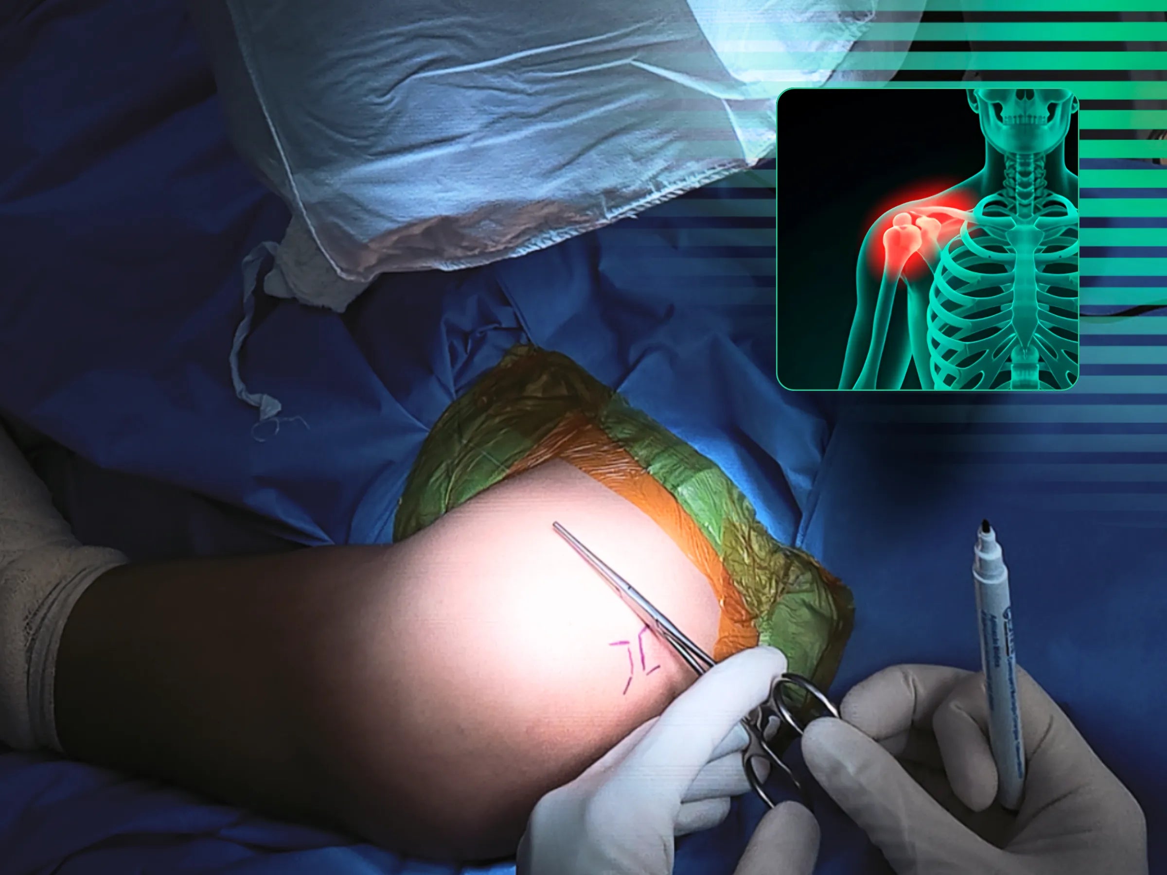 Luxação Acromioclavicular com Dispositivo TightRope 02