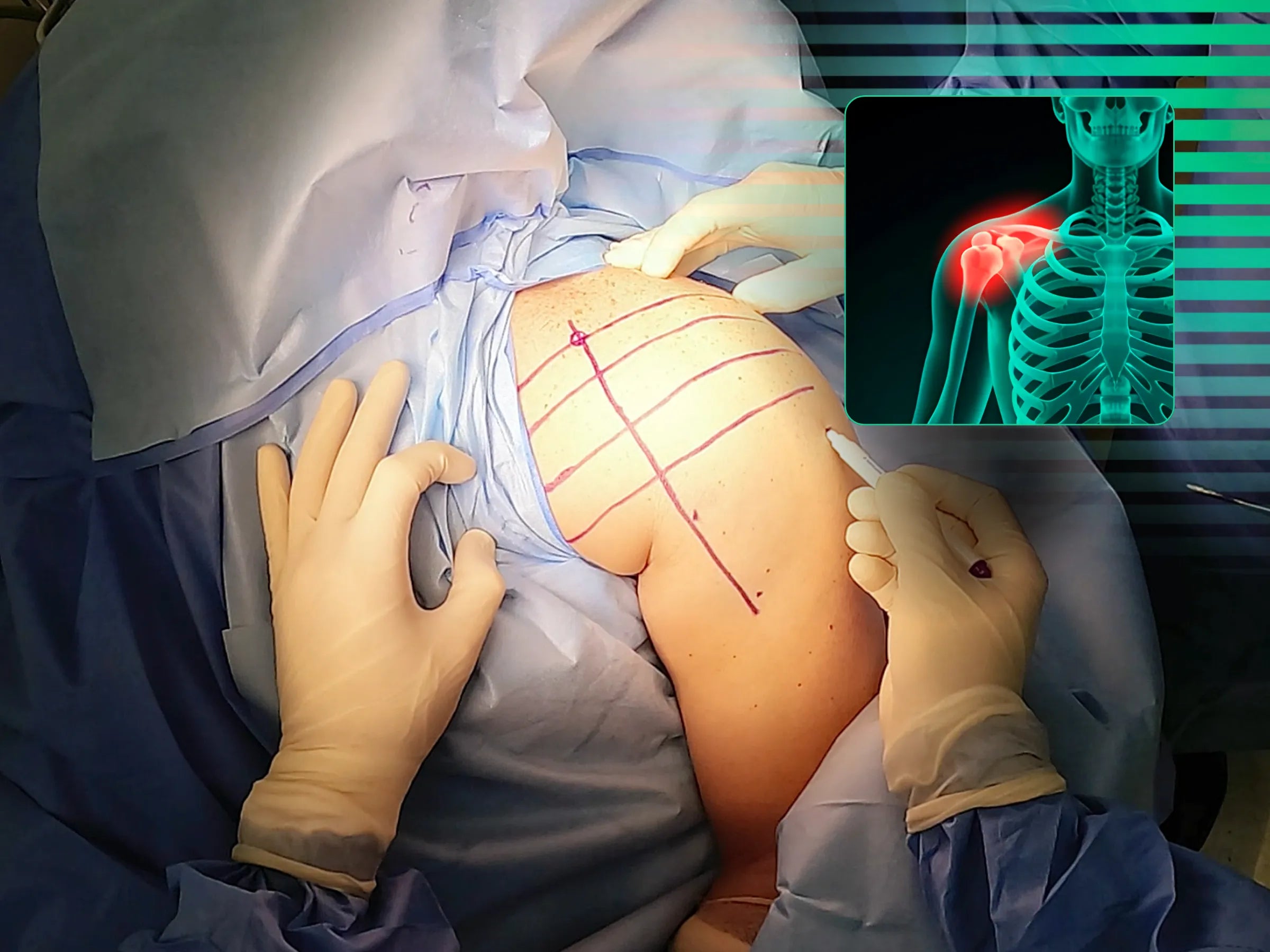 Luxação Posterior do Ombro com Impactação da Cabeça Umeral