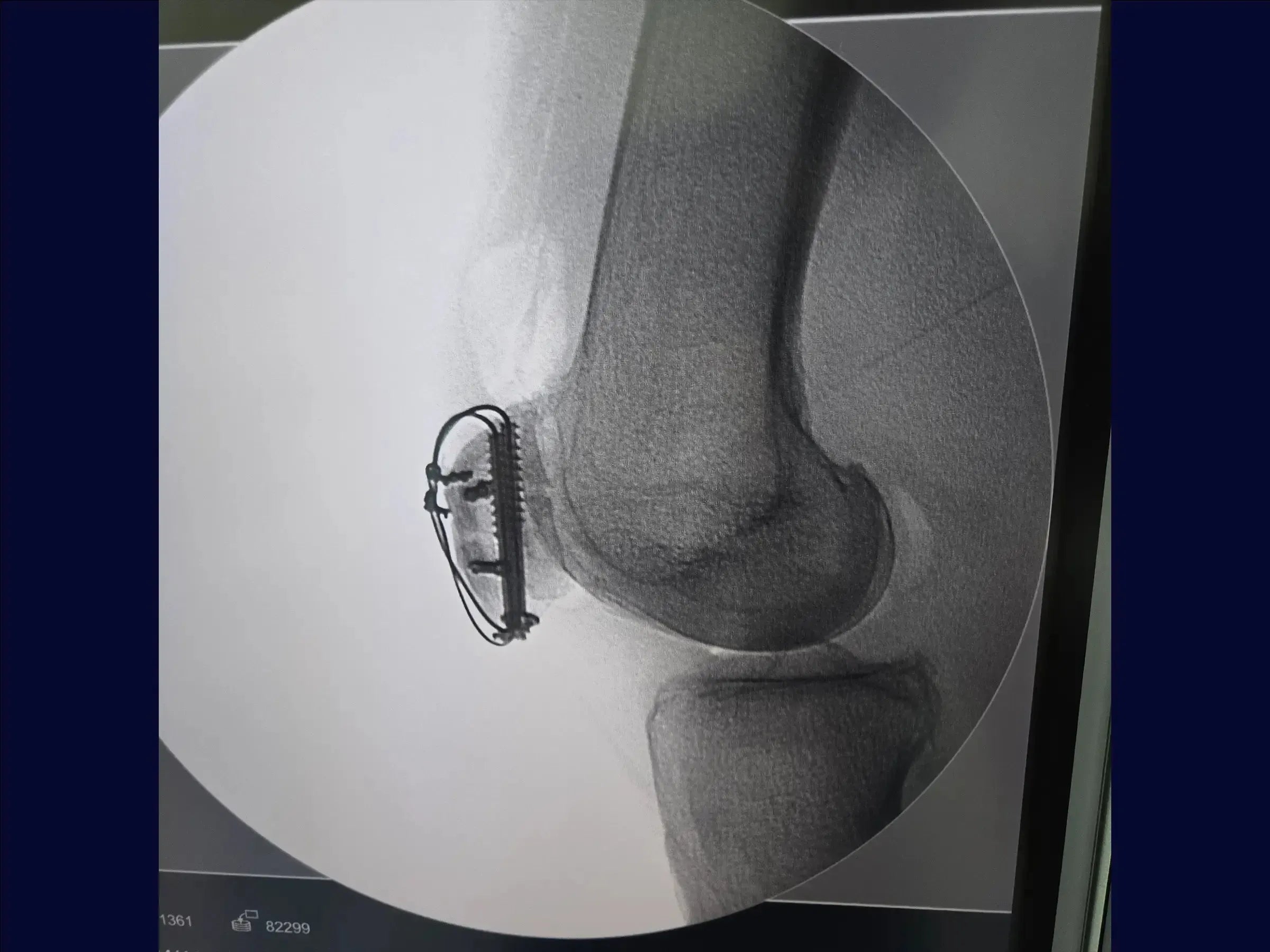 Multi-fragmentary Patella Fracture
