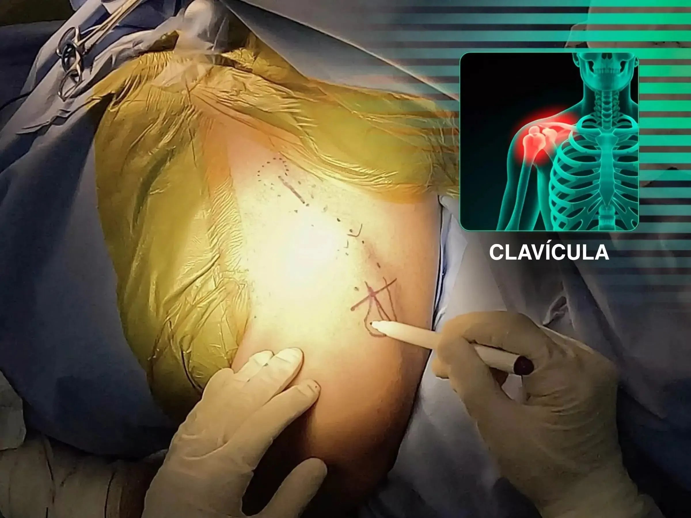 Osteossíntese Minimamente Invasiva de Fratura de Clavícula (Técnica em Ponte)
