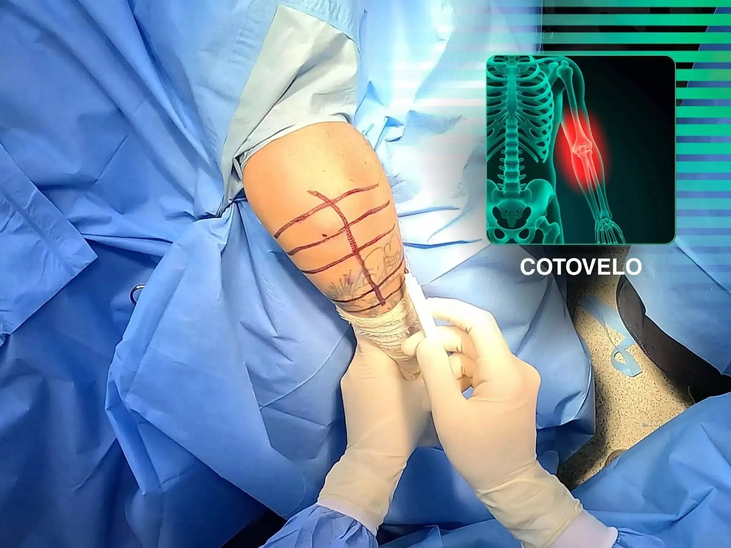 Osteossíntese Minimamente Invasiva de Fratura de Olécrano