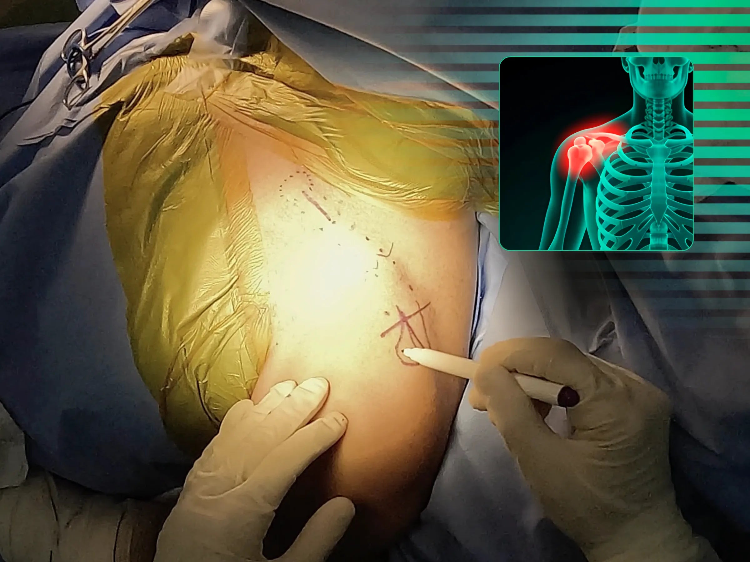 Osteossíntese Minimamente Invasiva de Fratura de Clavícula (Técnica em Ponte)