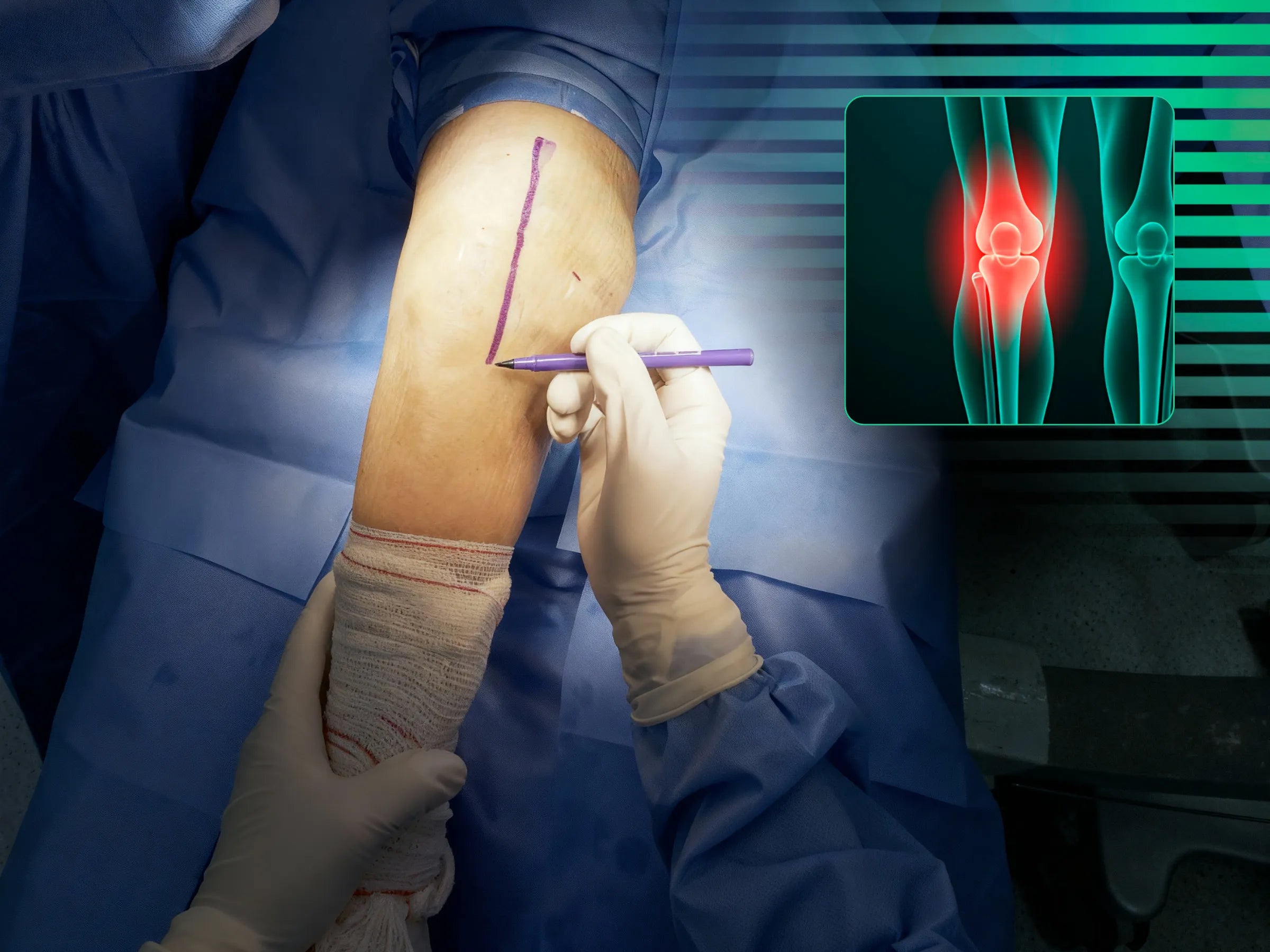 PATELA [Caso 2] · Parafusos Canulados + Cerclagem