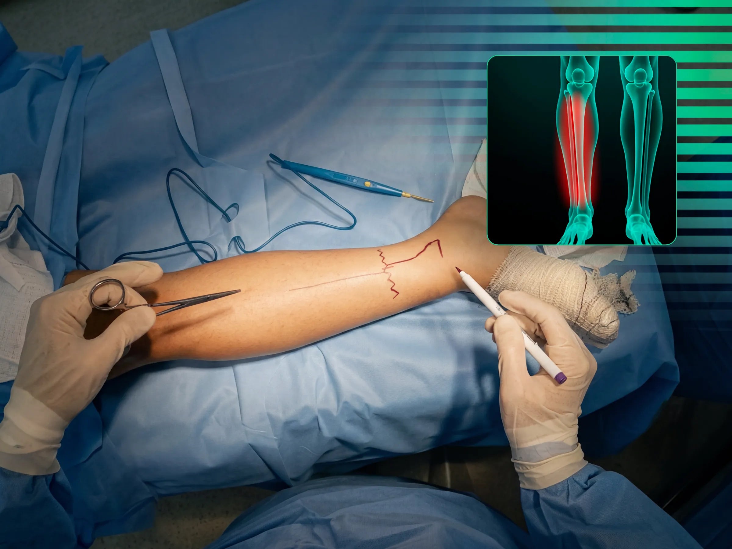 PILÃO TIBIAL [Caso 2] · Abordagem Póstero-Medial + Lateral