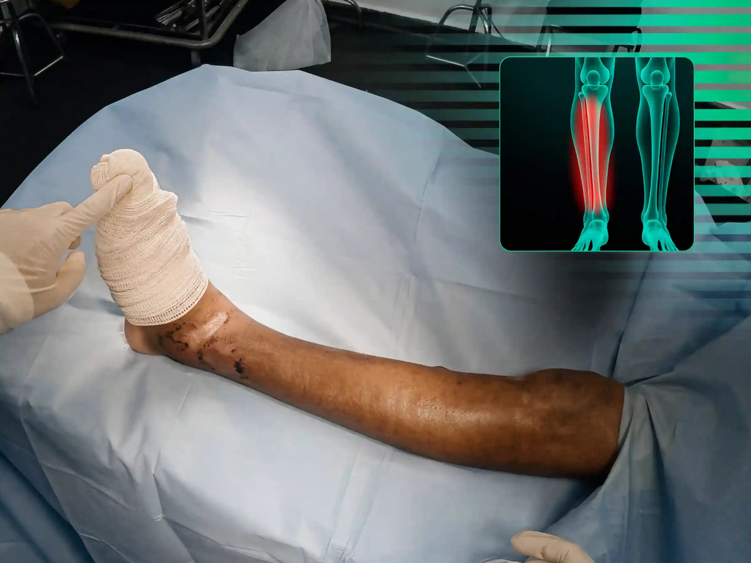 PILÃO TIBIAL [CASO 03] Abordagem Anterolateral e Posteromedial