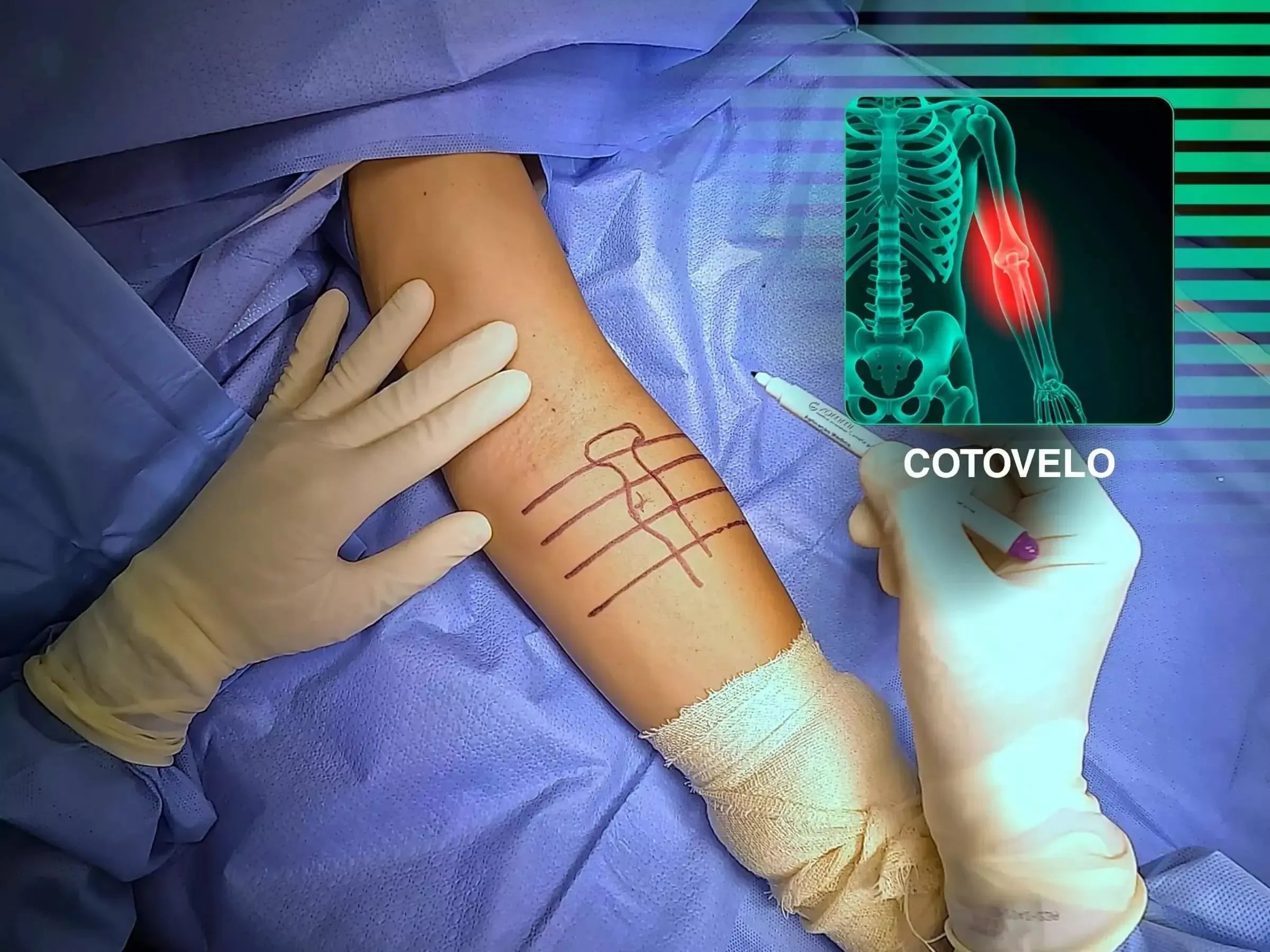 Reconstrução Anatômica do Tendão Distal do Bíceps com TightRope