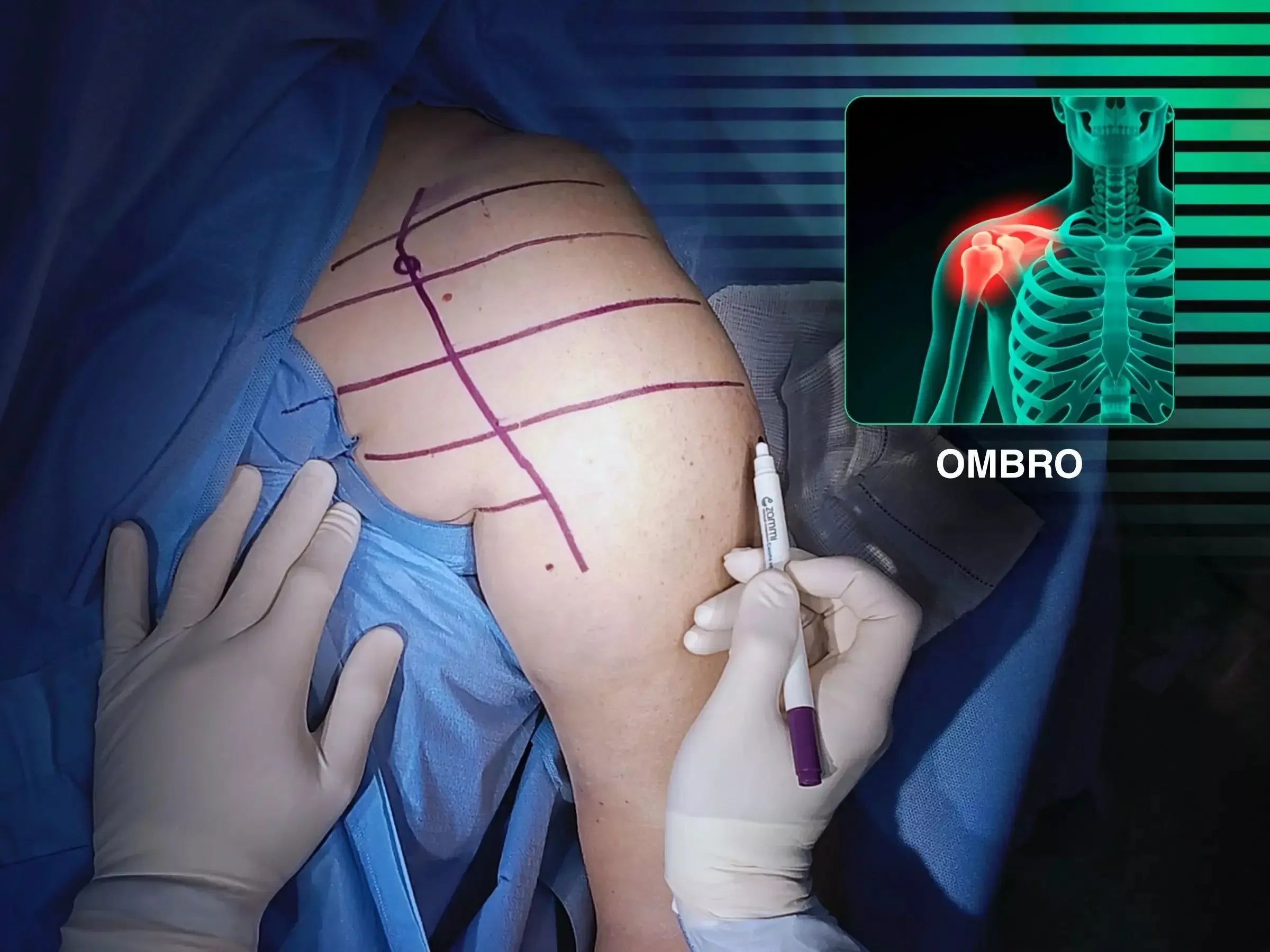 Reconstrução de Fratura Complexa em Quatro Partes do Úmero Proximal