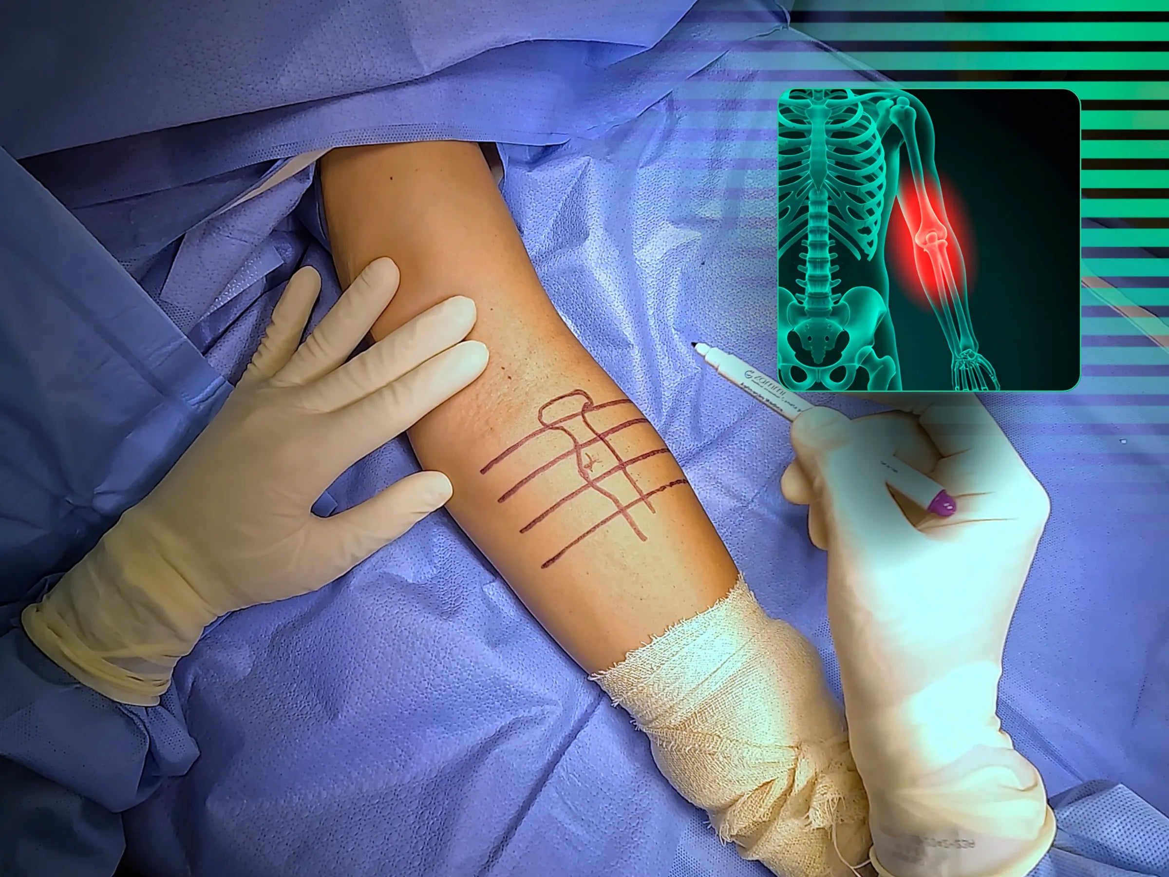 Reconstrução Anatômica do Tendão Distal do Bíceps com TightRope