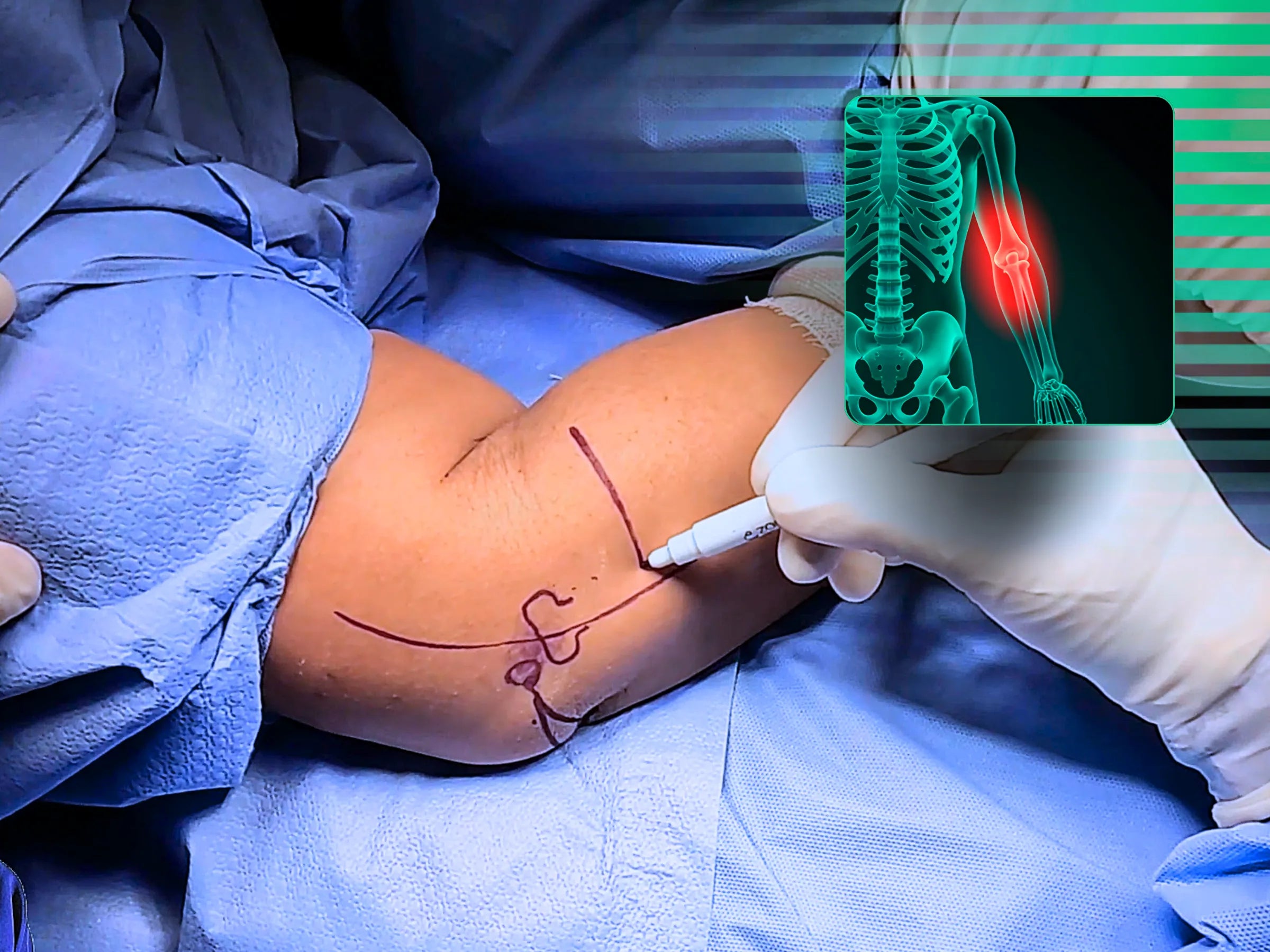 Reconstrução de Fratura Multifragmentar da Cabeça do Rádio (Mason 3) com Instabilidade Associada