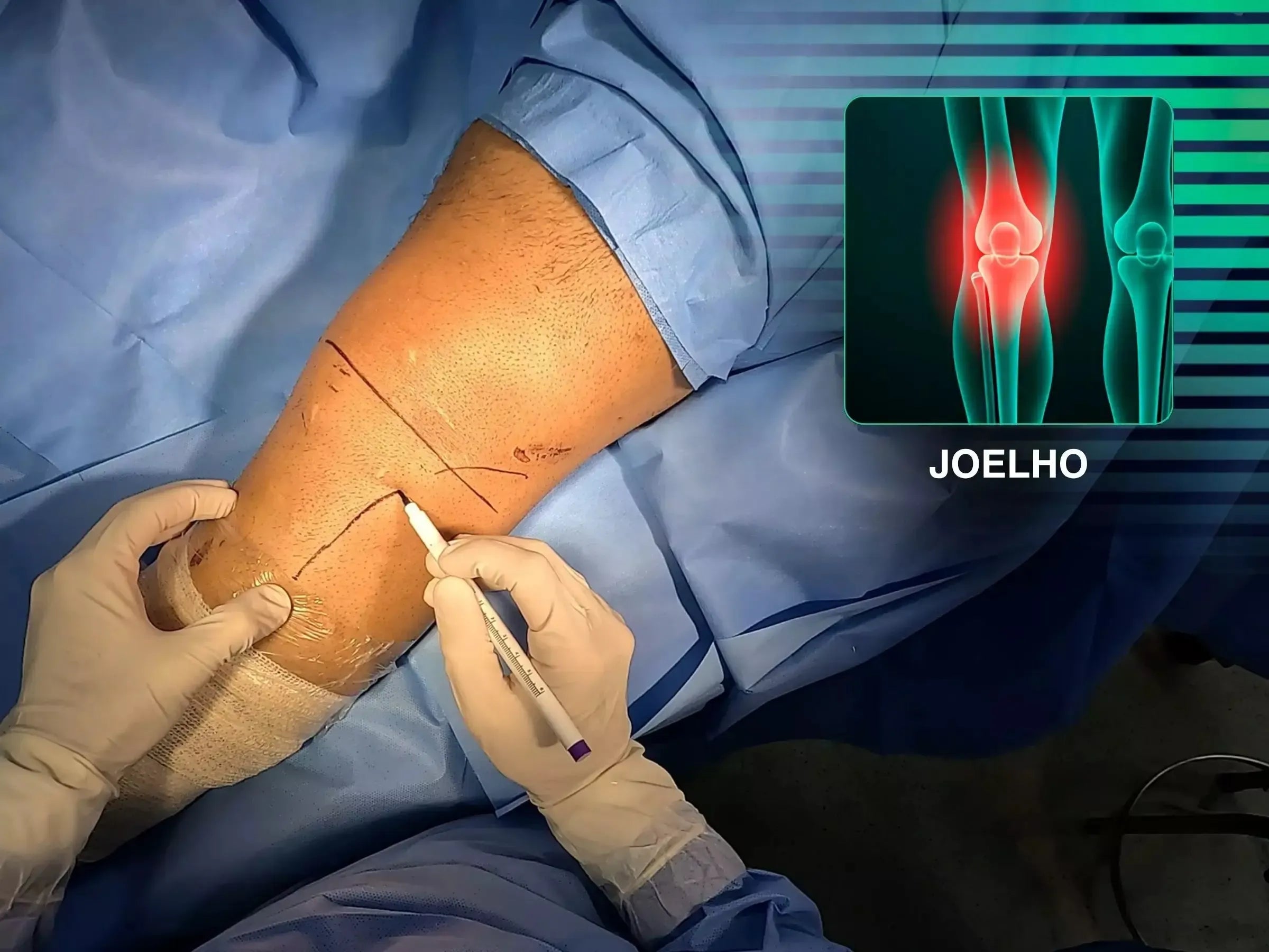 Tibial Plateau Fracture with Central Depression (Anterolateral Approach and Incomplete Osteotomy)