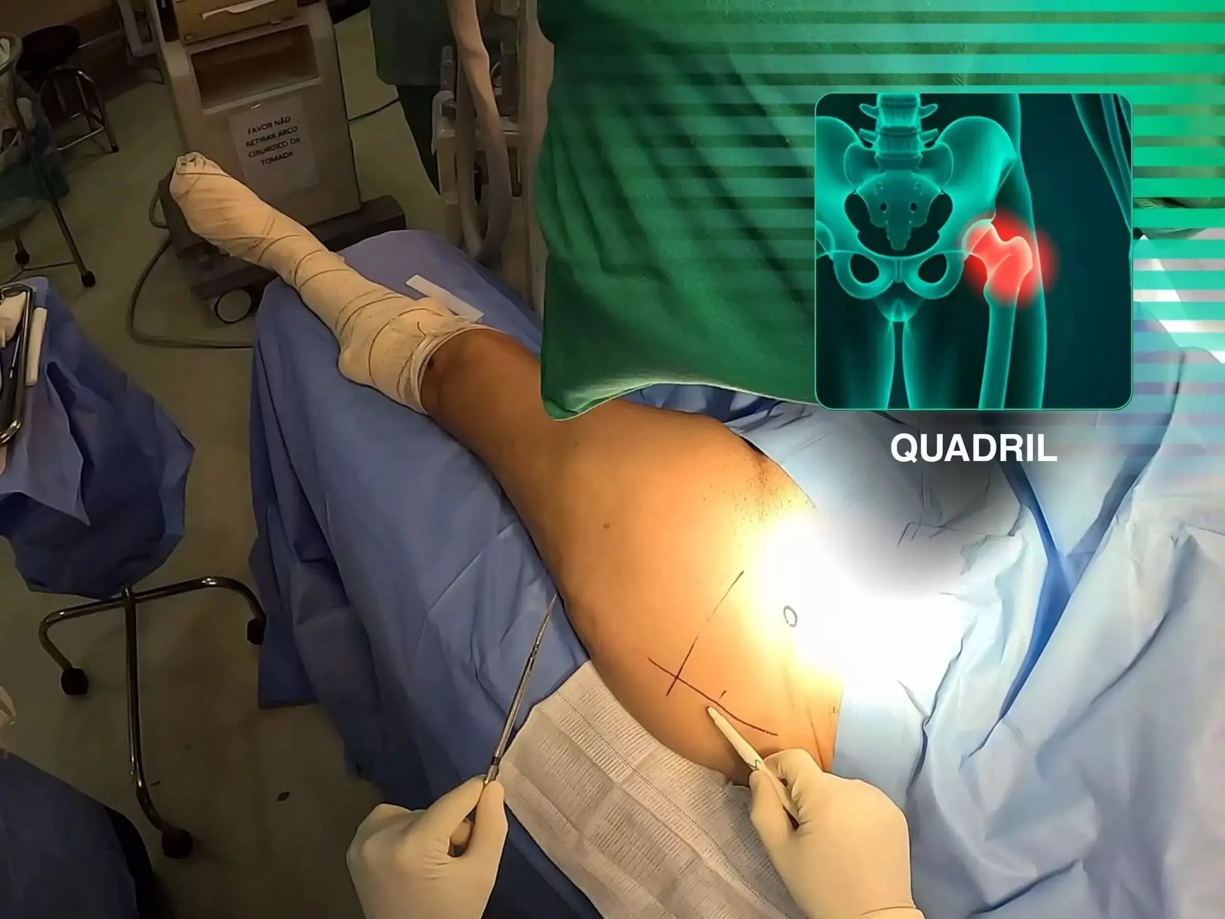 Transtrochanteric Fracture with Intramedullary Nail (Without Traction Table)