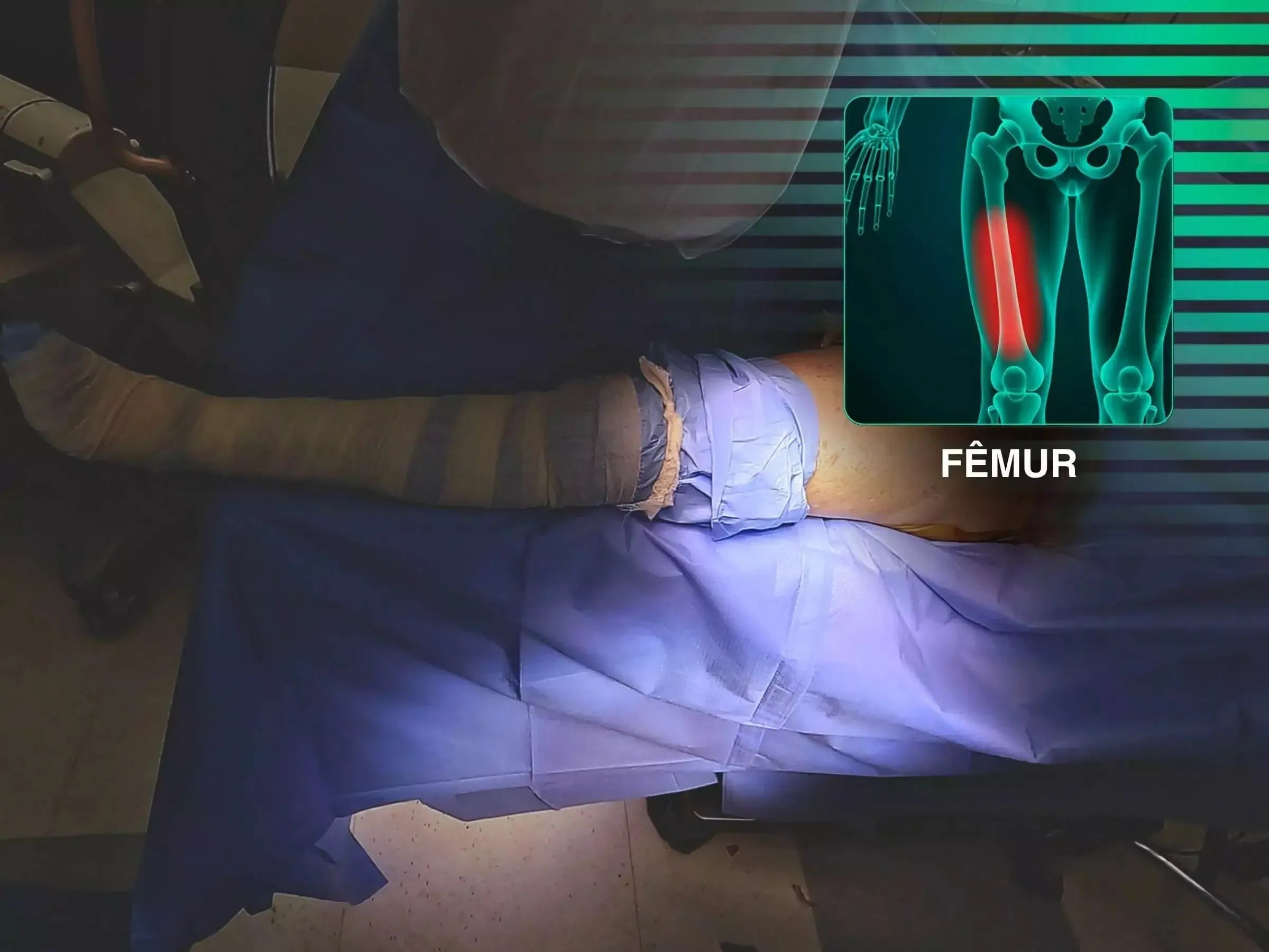 Tratamento de Fratura de Fêmur Proximal com Haste Intramedular e Manobra de Gangorra