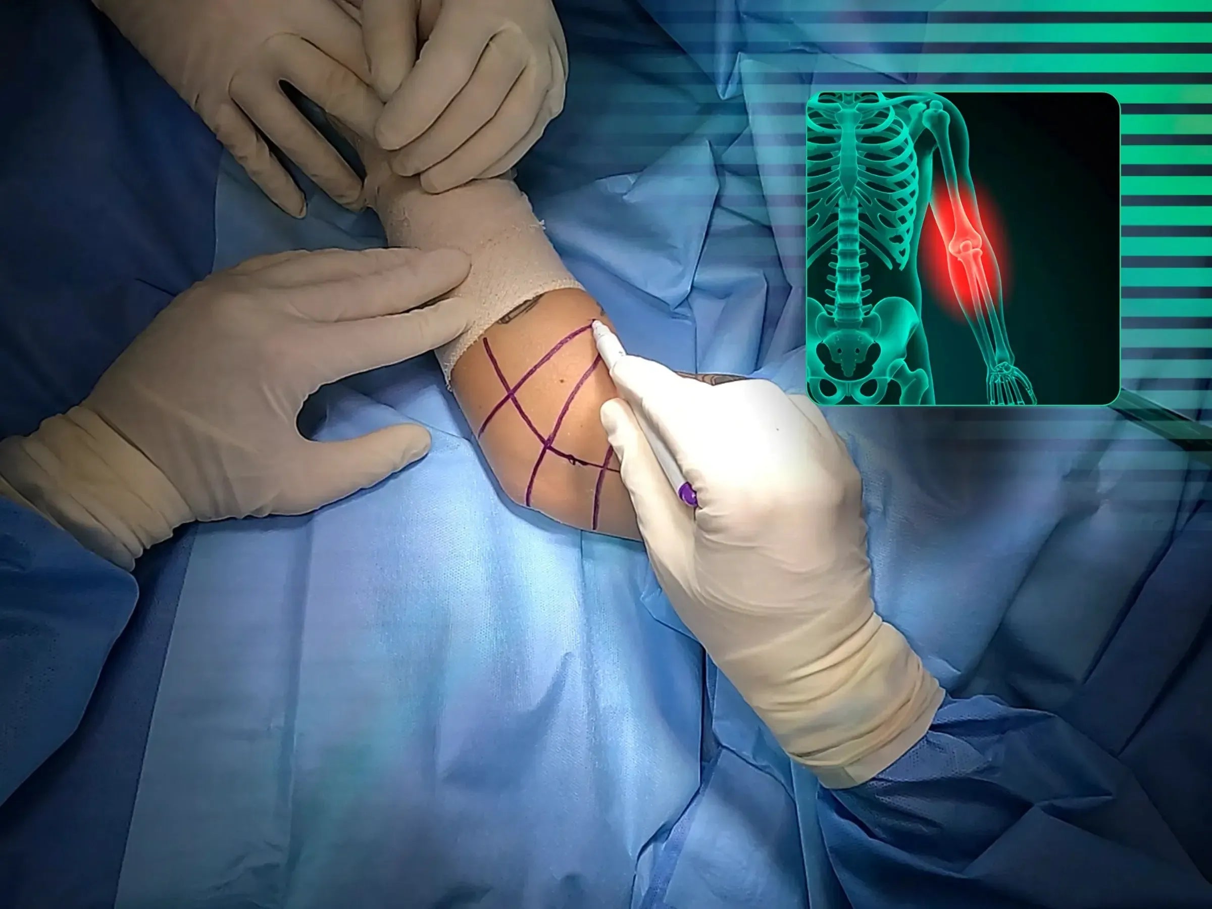 Terrible Triad of the Elbow
