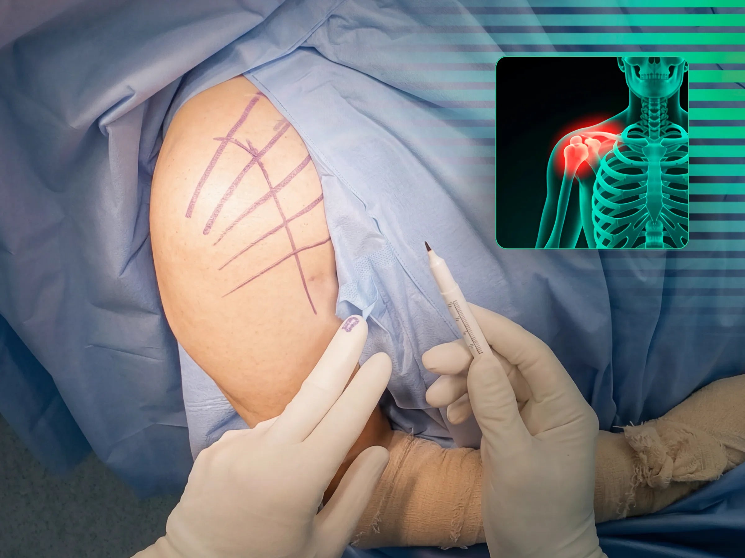 ÚMERO PROXIMAL [Caso 6] · Duas Partes · Placa e Parafusos