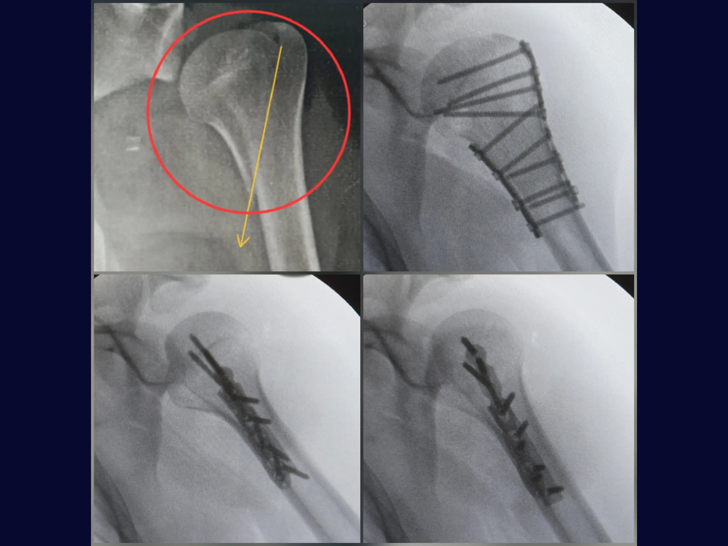 Osteossíntese do Úmero Proximal – Placa Medial