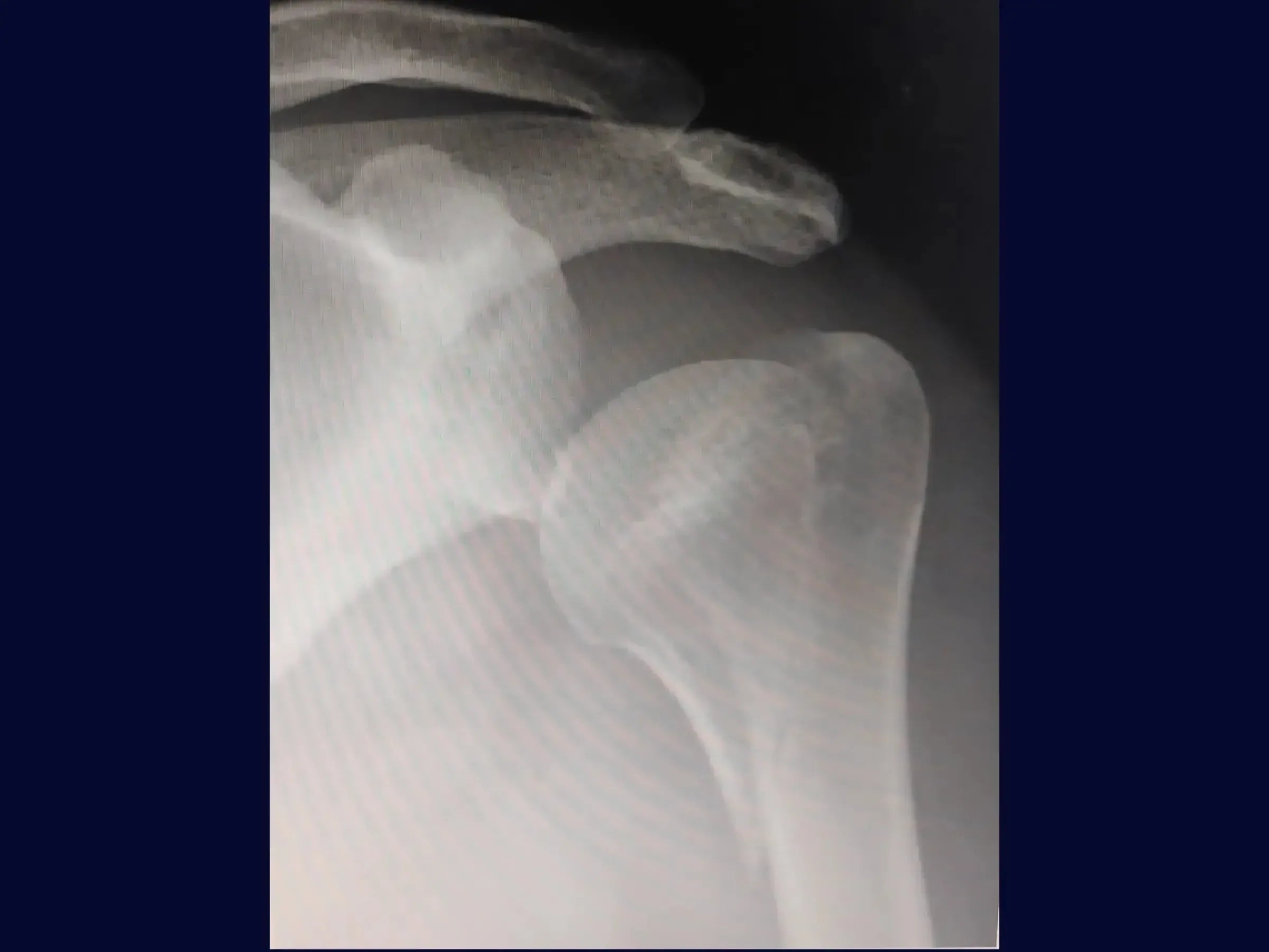 Proximal Humerus Osteosynthesis – Medial Plate