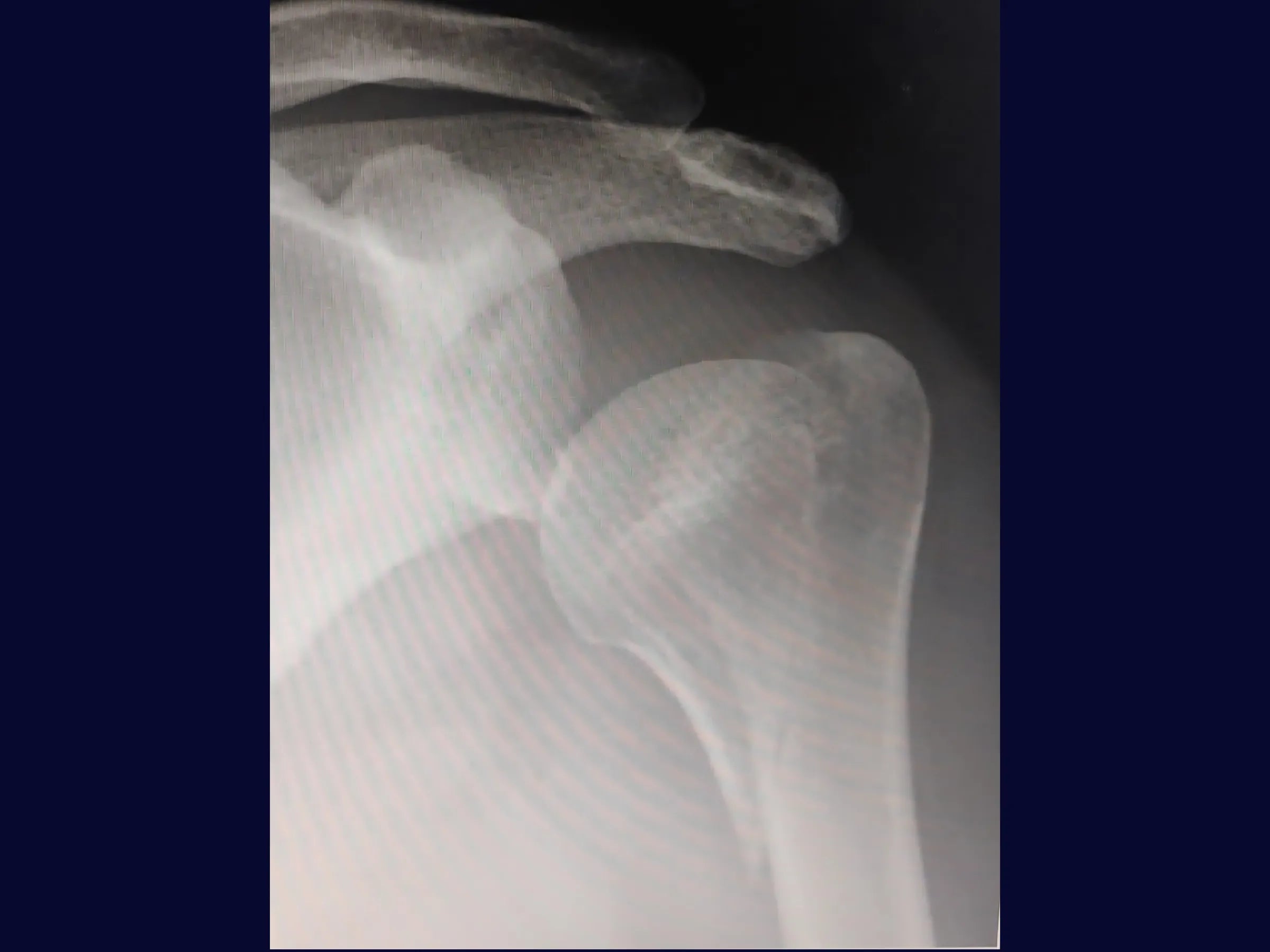 Osteossíntese do Úmero Proximal – Placa Medial