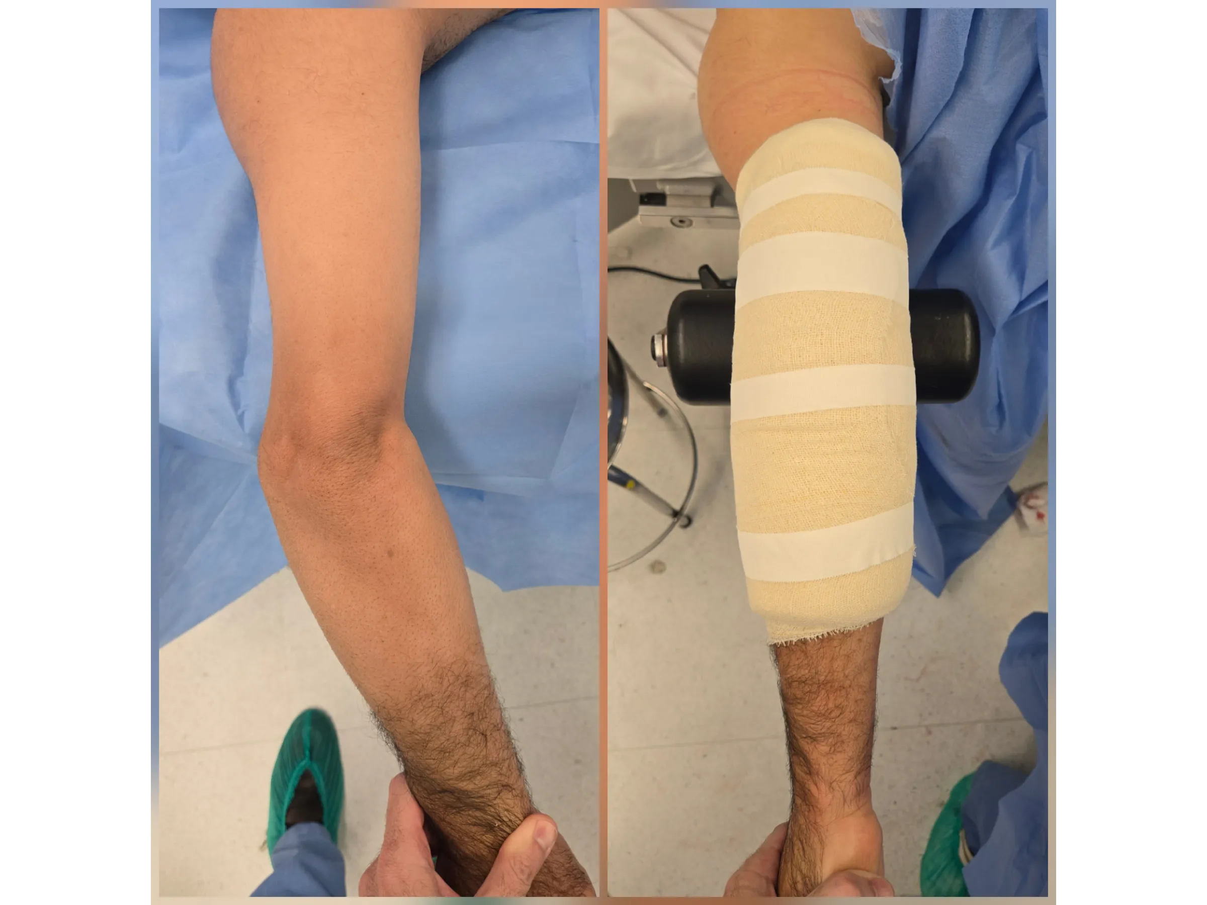 Osteotomia do Úmero Distal – Cúbito Varo