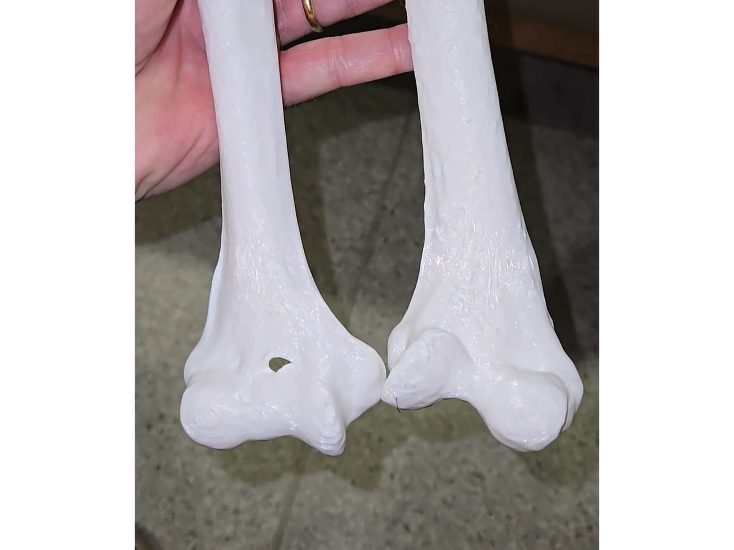 Osteotomia do Úmero Distal – Cúbito Varo