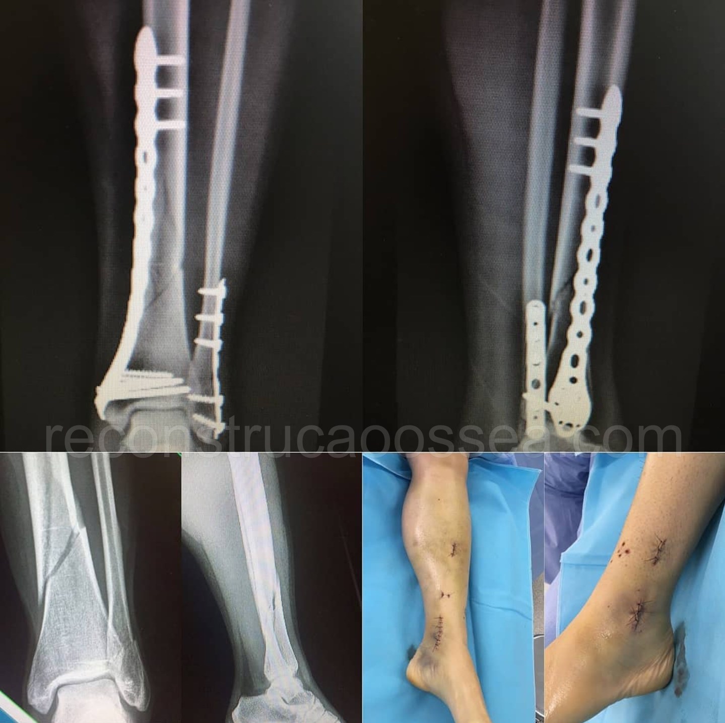 cirurgia-ortopedica-minimamente-invasiva-1