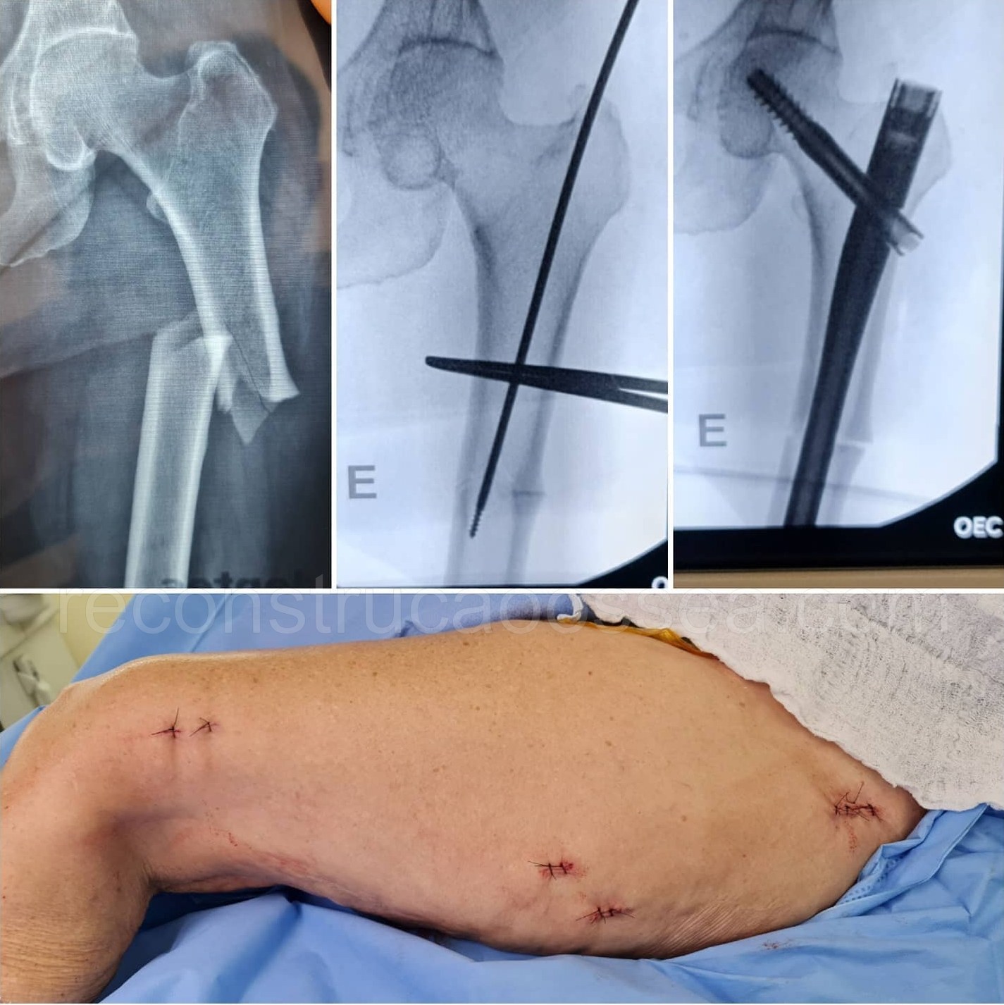 cirurgia-ortopedica-minimamente-invasiva-11