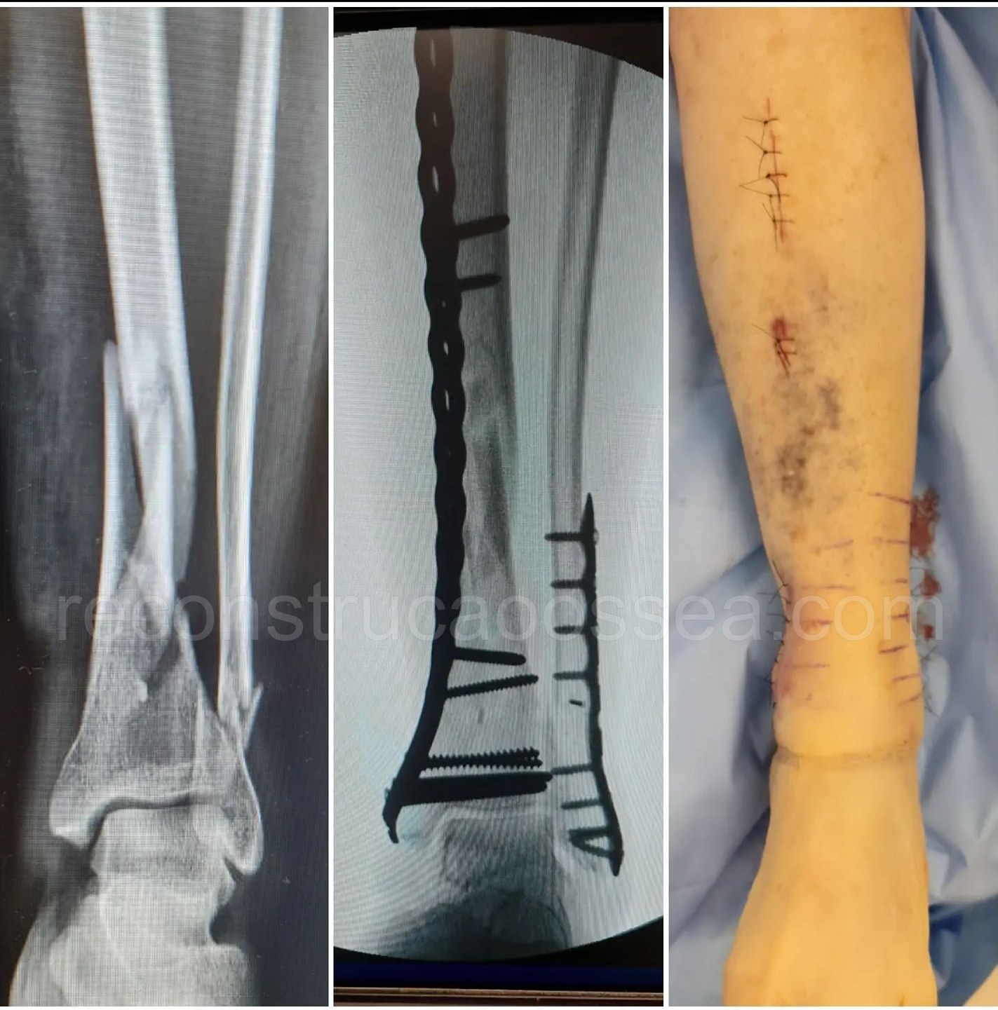 cirurgia-ortopedica-minimamente-invasiva-16