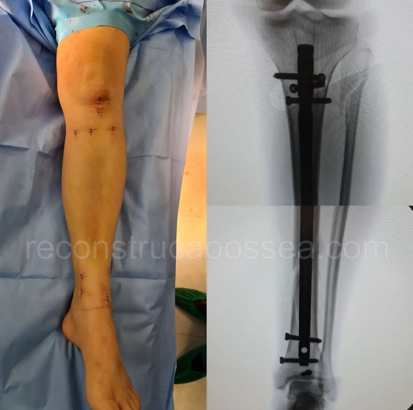 cirurgia-ortopedica-minimamente-invasiva-18