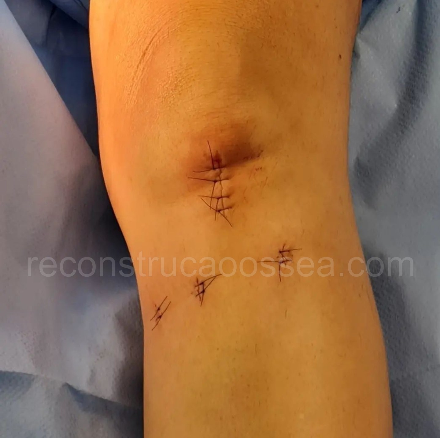 cirurgia-ortopedica-minimamente-invasiva-19