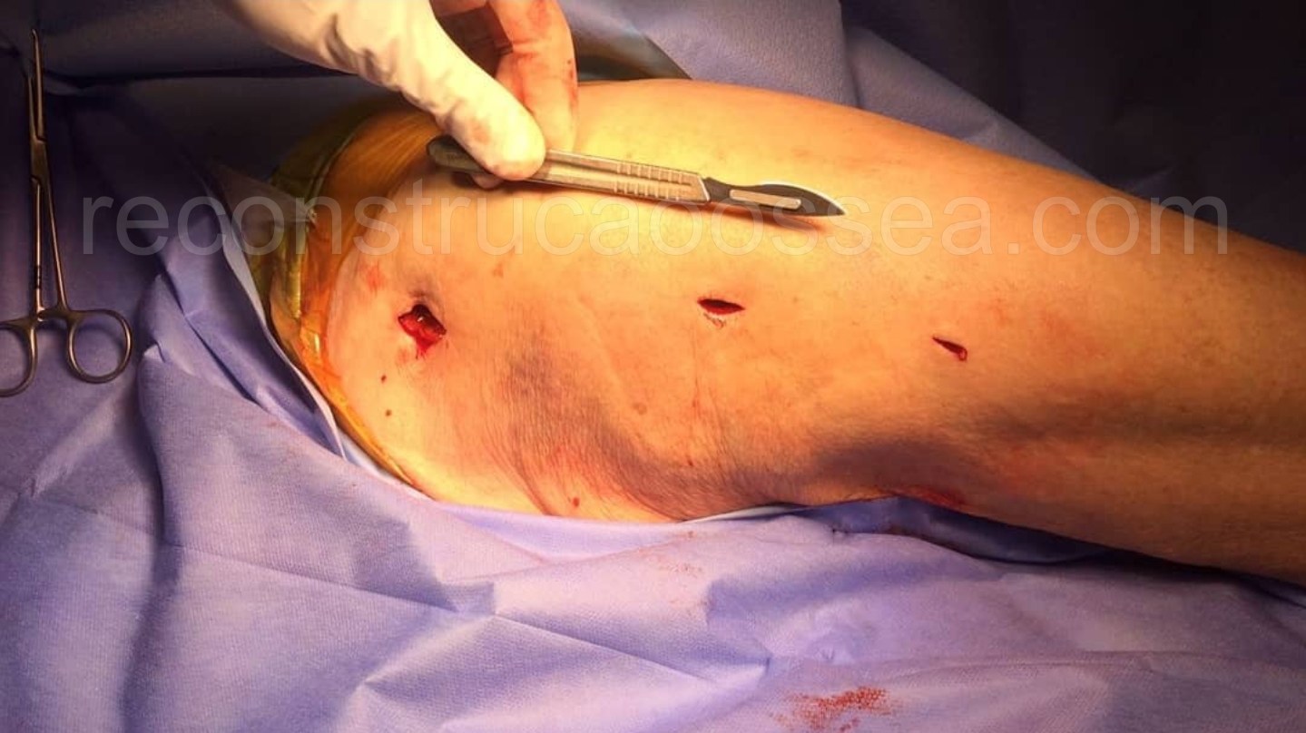 cirurgia-ortopedica-minimamente-invasiva-2