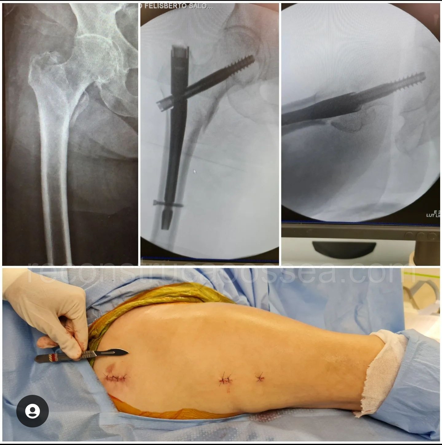 cirurgia-ortopedica-minimamente-invasiva-21