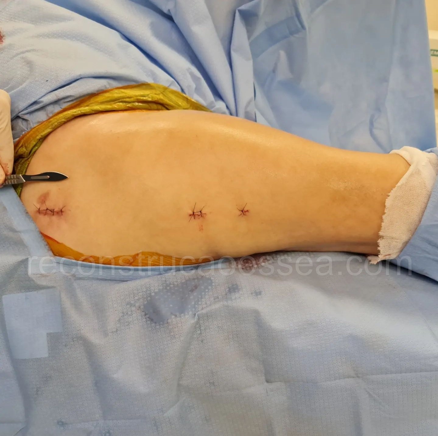cirurgia-ortopedica-minimamente-invasiva-22