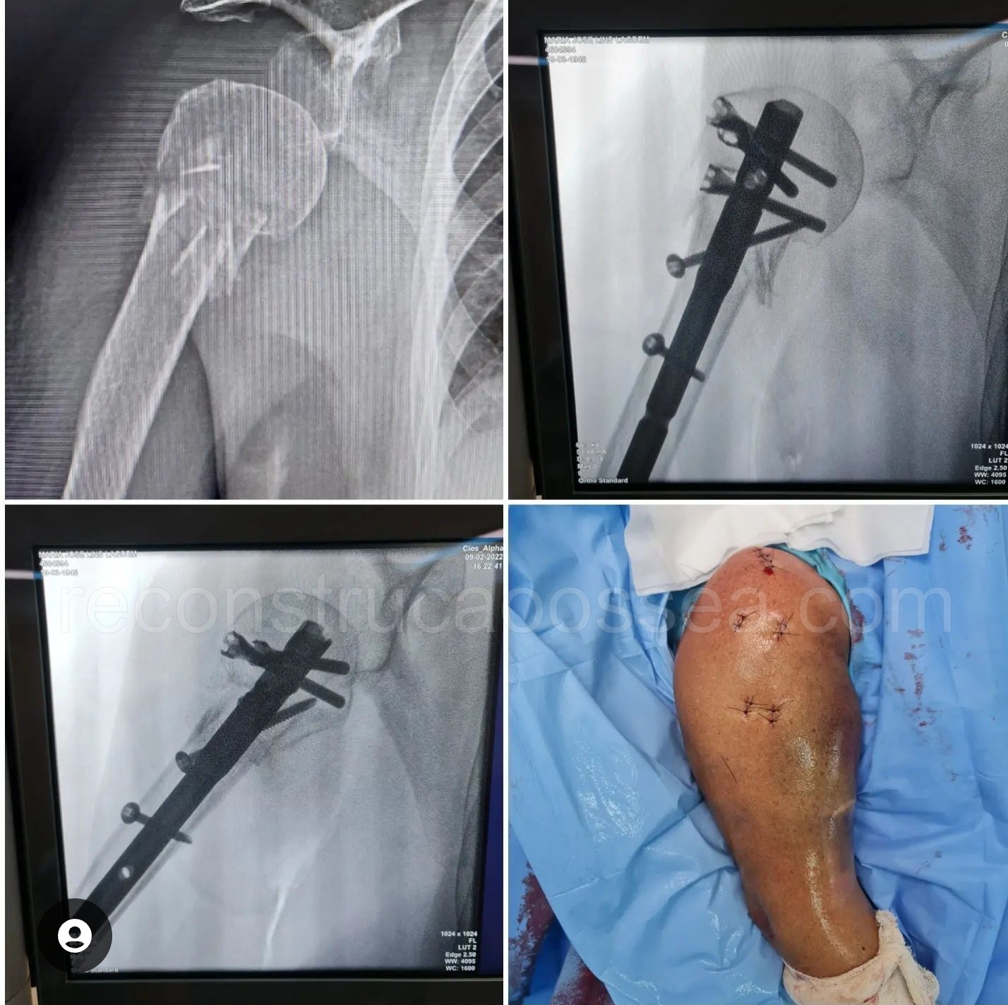 cirurgia-ortopedica-minimamente-invasiva-23