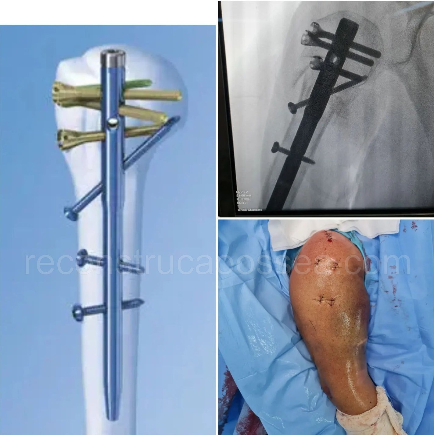 cirurgia-ortopedica-minimamente-invasiva-24