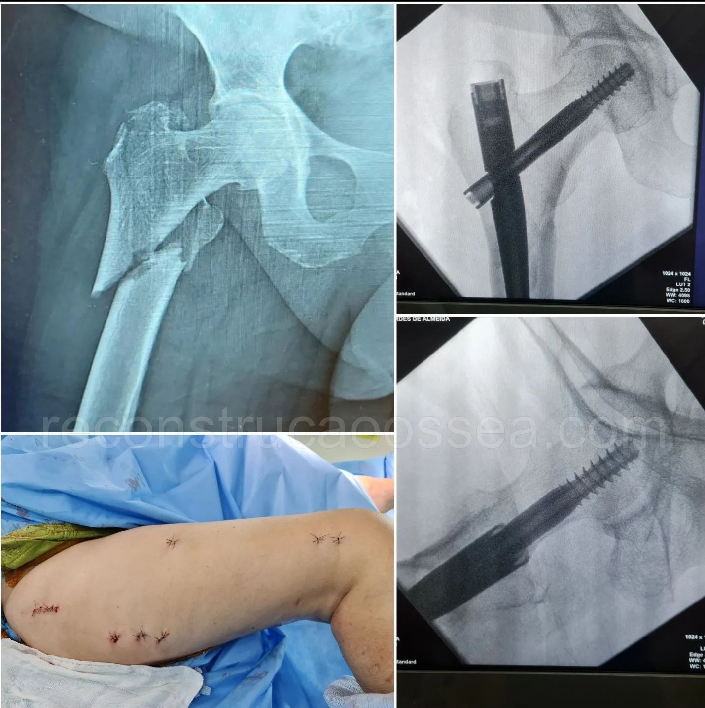 cirurgia-ortopedica-minimamente-invasiva-26