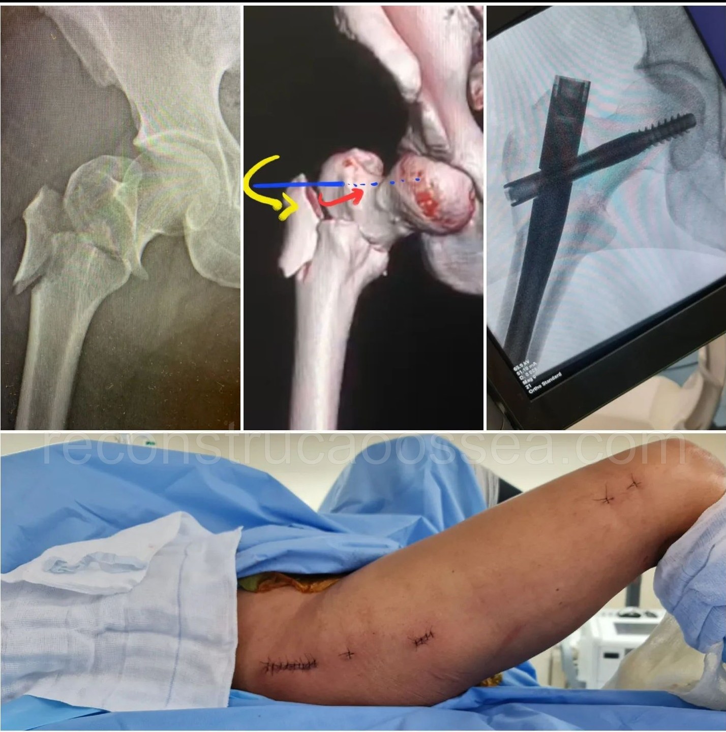 cirurgia-ortopedica-minimamente-invasiva-28