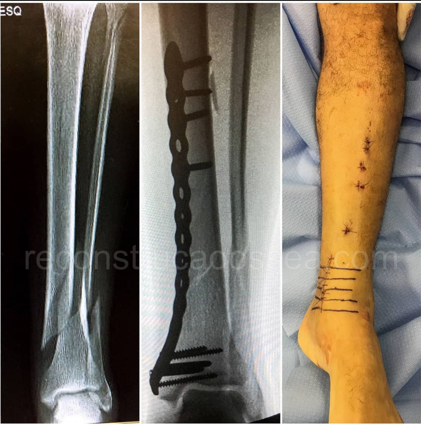 cirurgia-ortopedica-minimamente-invasiva-3