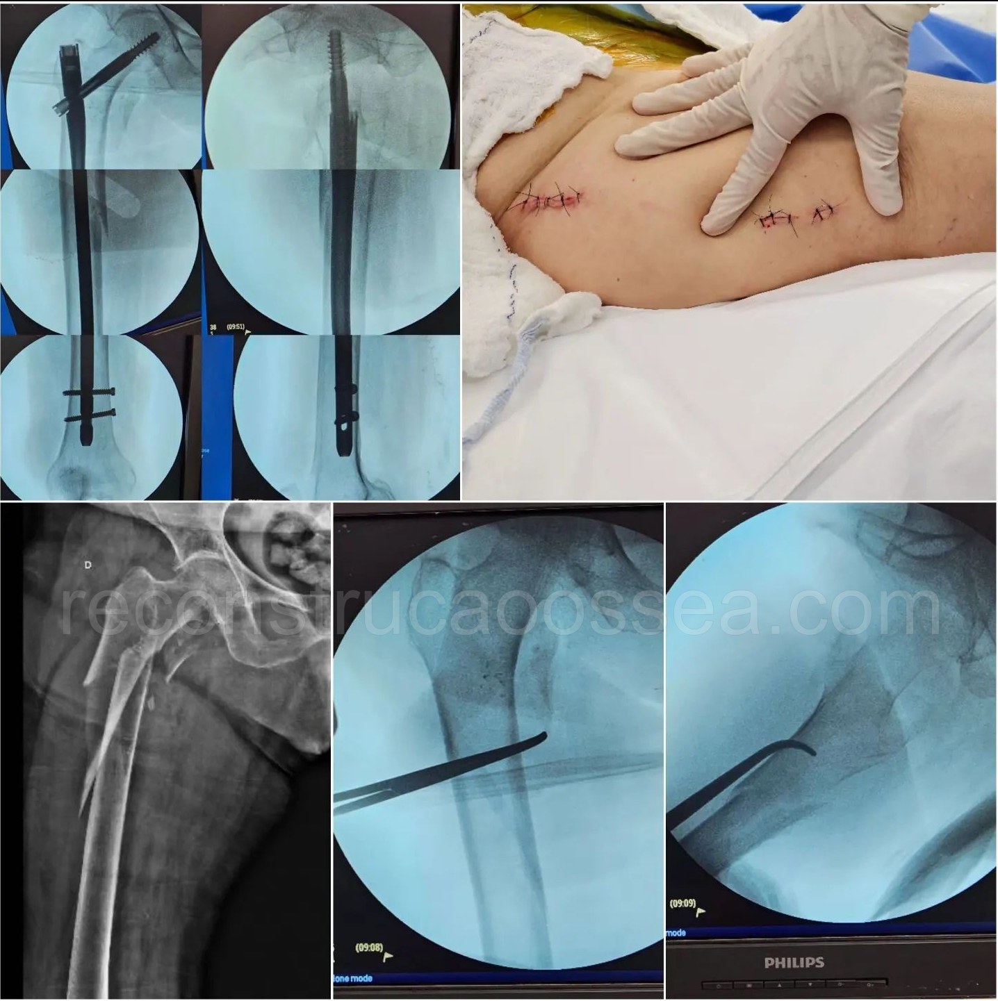 cirurgia-ortopedica-minimamente-invasiva-35
