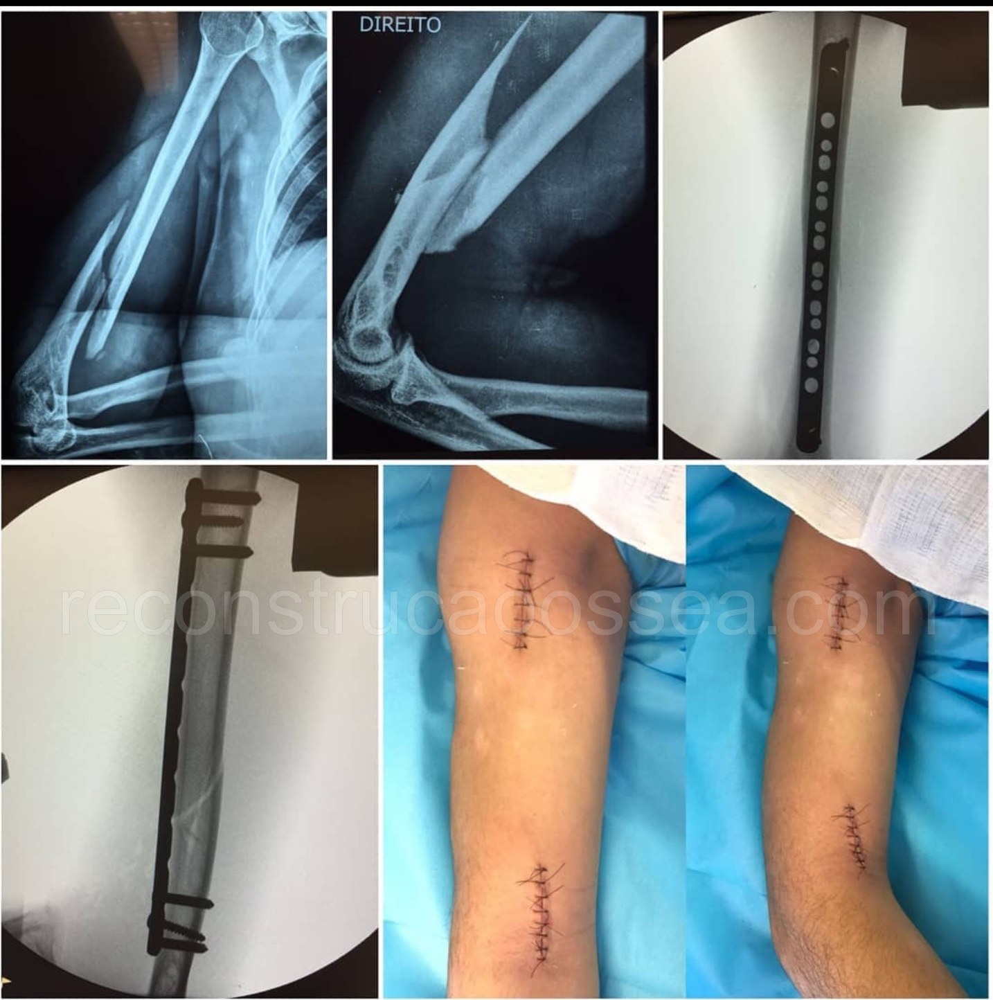 cirurgia-ortopedica-minimamente-invasiva-5