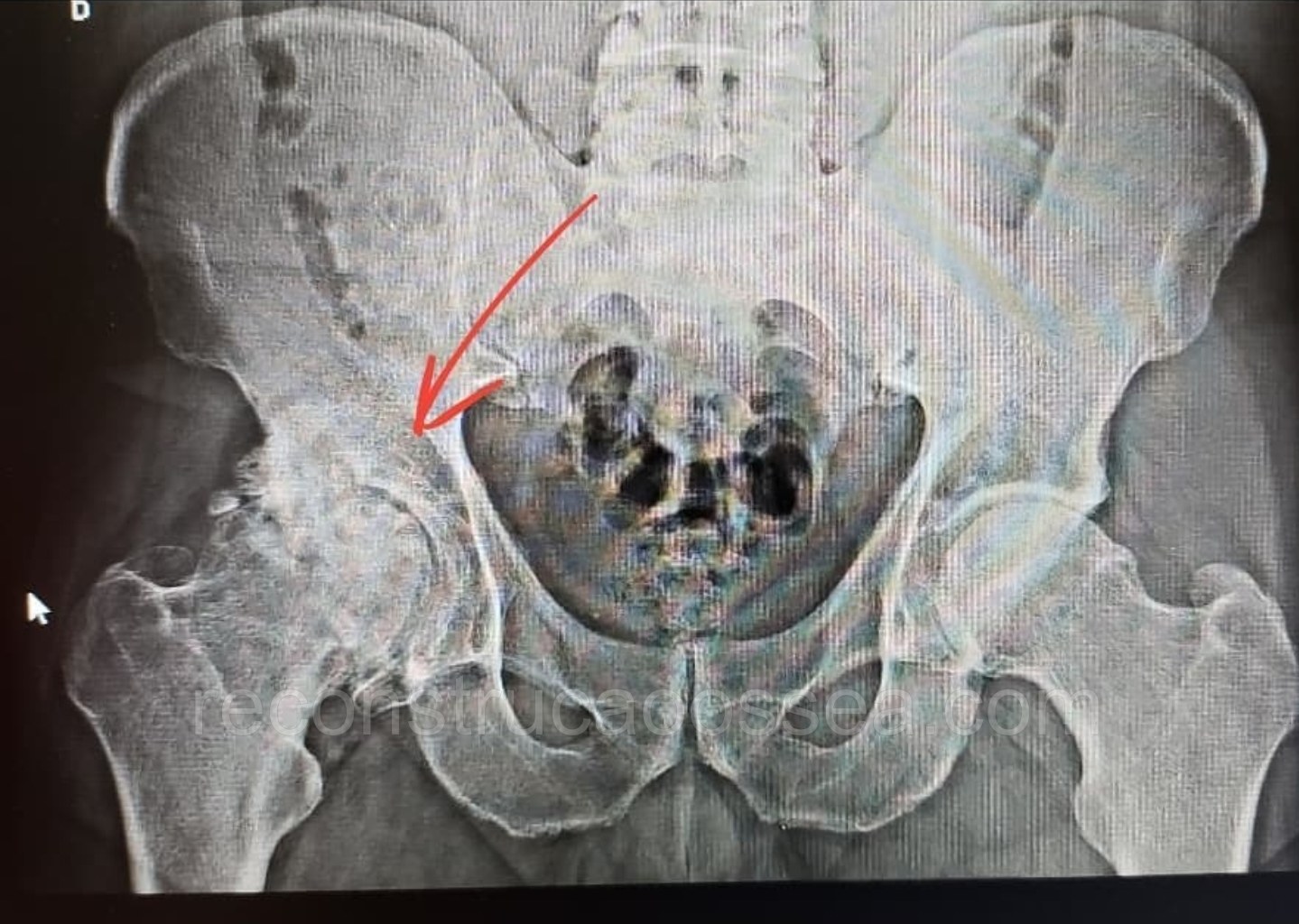 artroplastia-do-quadril-2